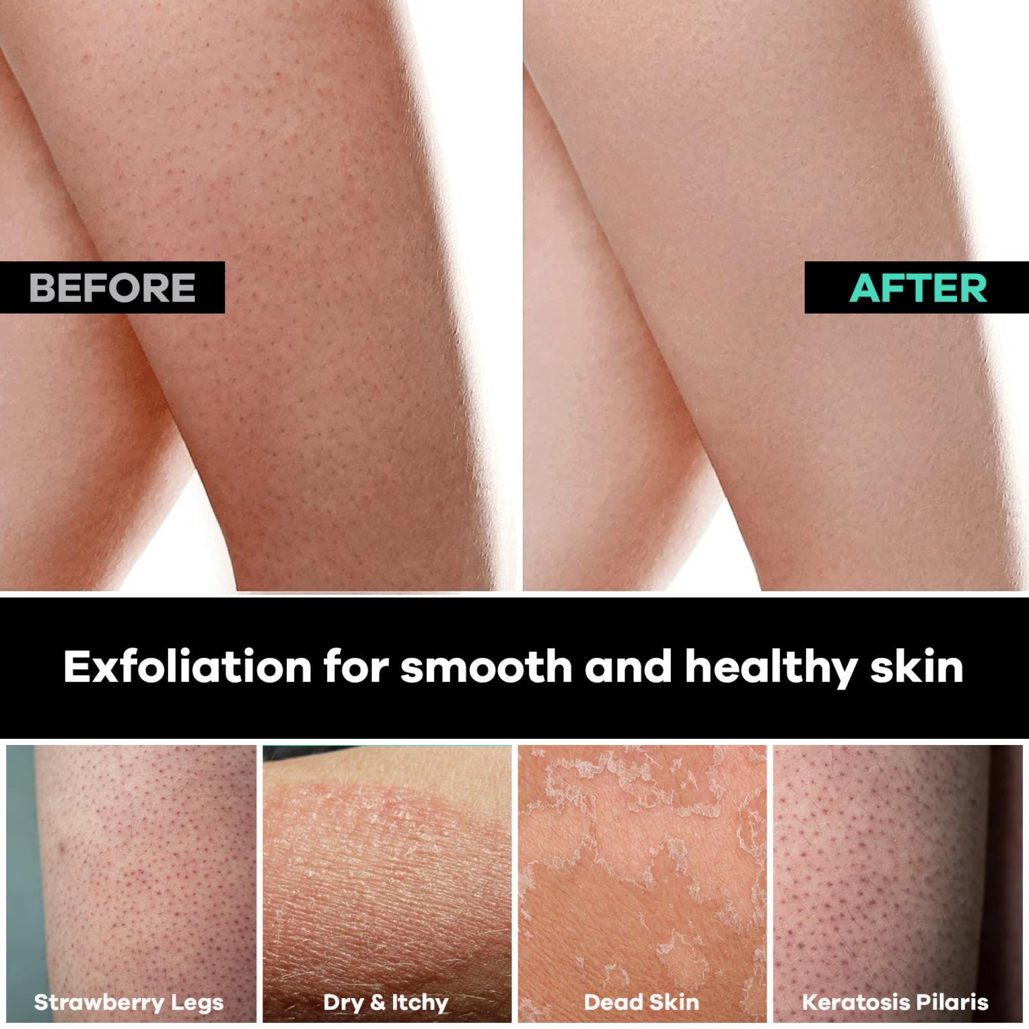 Dermasuri - Deep Exfoliating Glove - Polishing Mitt Body Scrubber - Korean Skin Cleaner Exfoliator - Dead Skin Buffing Treatment - Gifts for Women & Men - Keratosis Pilaris Scrub Remover - (2 Pack)