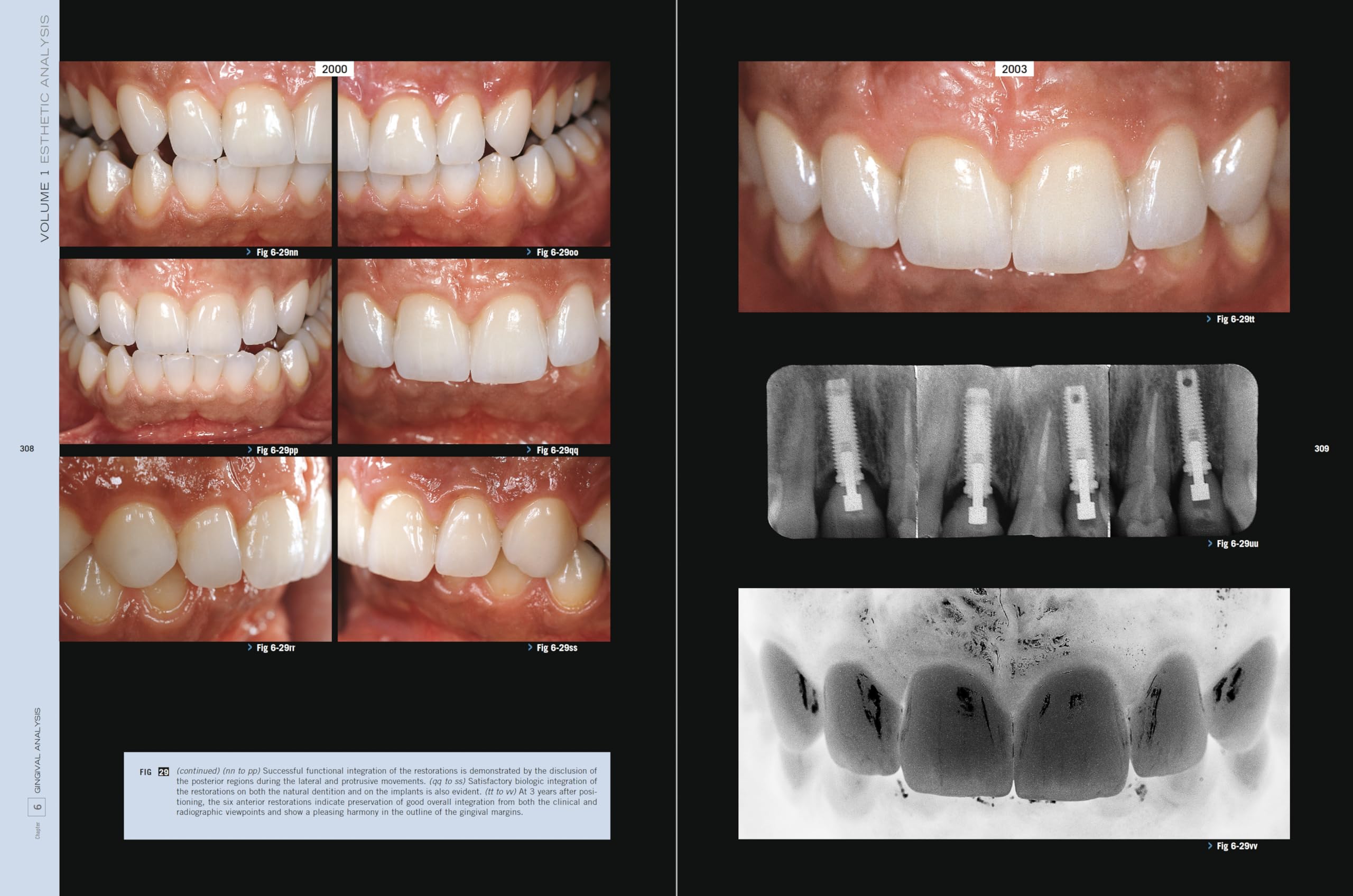 Esthetic Rehabilitation In Fixed Prosthodontics: Esthetic Analysis: A Systematic Approach To Prosthetic Treatment Esthetic Rehabilitation In Fixed Prosthodontics: Esthetic Analysis: A Systematic Approach To Prosthetic Treatment Hardcover