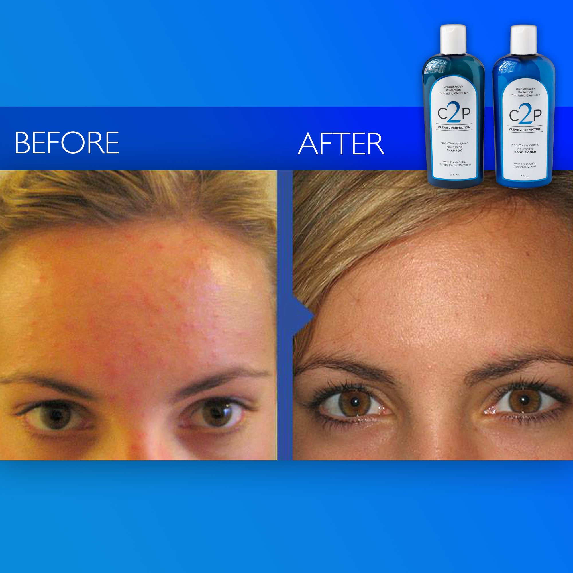 Hair Conditioner for Blemish Free Skin by Clear 2