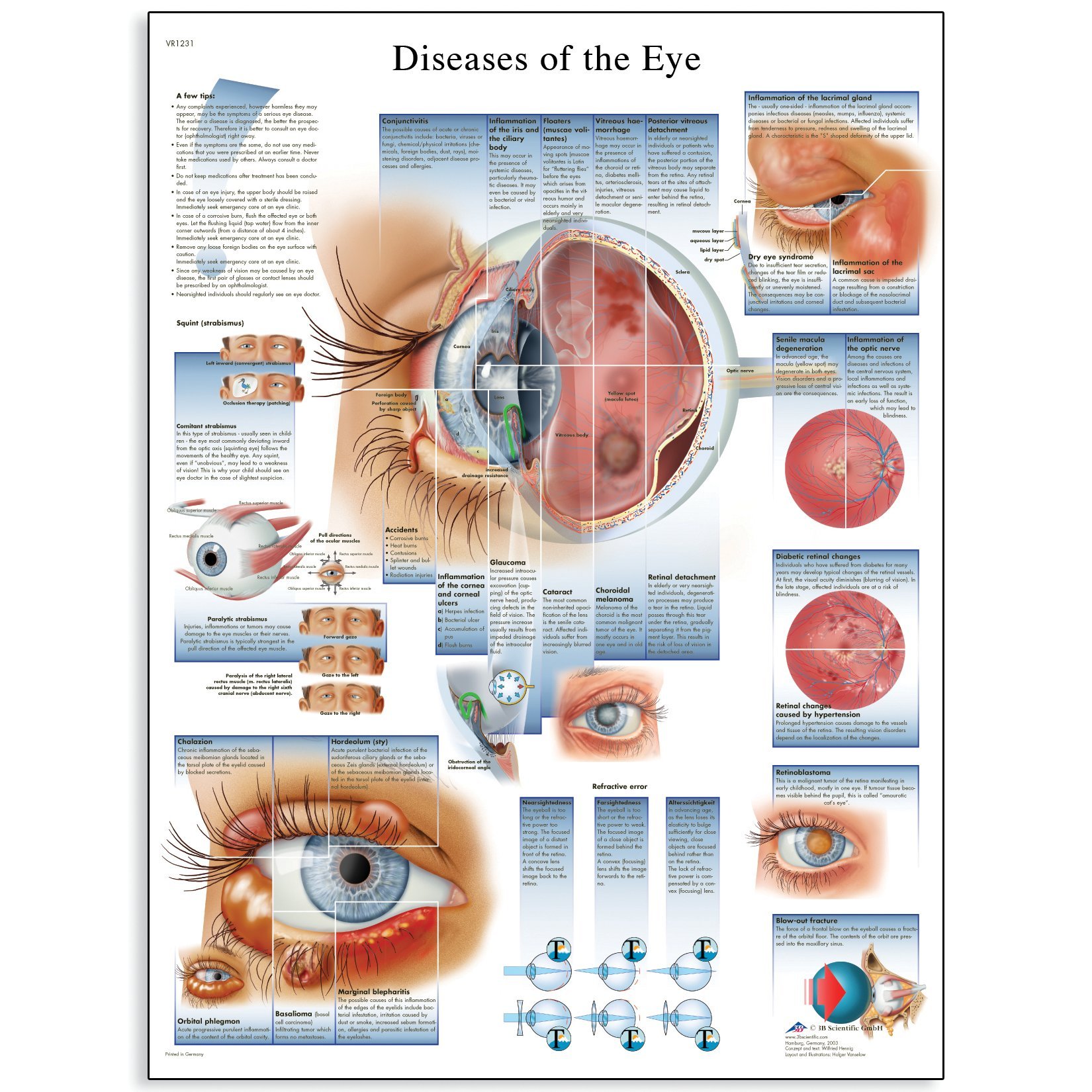 3B Scientific VR1231UU Human Anatomy - Diseases of the Eye Chart, Paper Version, unlaminated