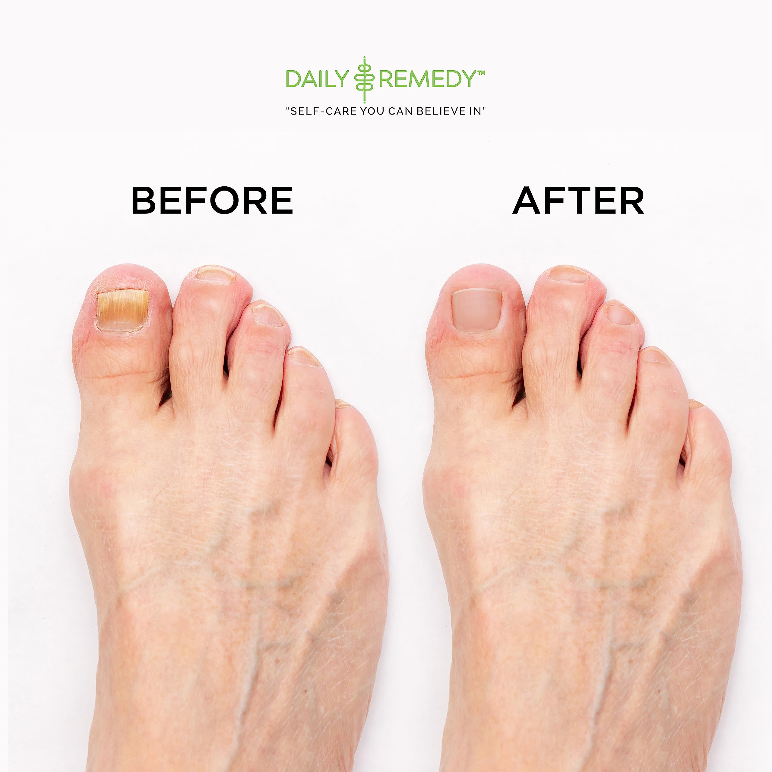 DAILY REMEDY EXTRA STRENGTH Tea Tree Oil Foot Soak w/ Epsom Salt Made in USA Toenails，Athlete's Foot，Itchy Feet，Stubborn Smelly Foot Odor，Pedicure Calluses & Soothes Sore Tired Achy Feet 16 oz，Black
