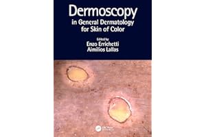 Dermoscopy in General Dermatology for Skin of Color