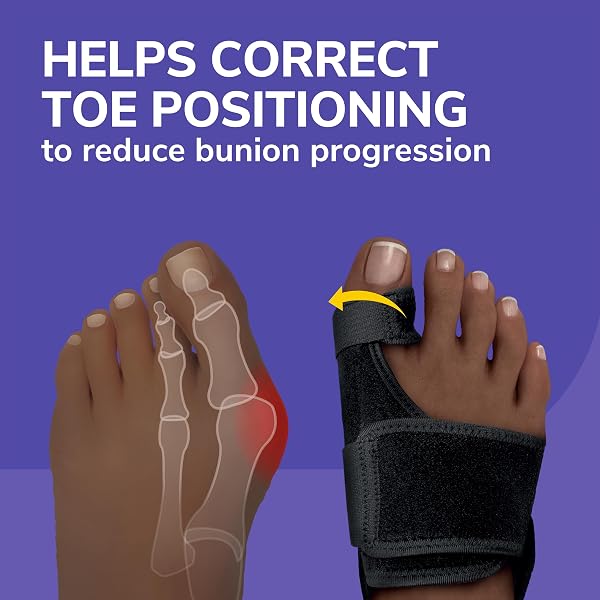 DR. SCHOLL’S BUNION RELIEF & TOE CORRECTOR // MASSAGING GEL BUNION SPLINT & BIG TOE STRAIGHTENER – ORTHOPEDIC BUNION CORRECTOR FOR WOMEN & MEN – BUNION PADS FOR BUNION PAIN RELIEF, 1 SUPPORT SET (LEFT & RIGHT)