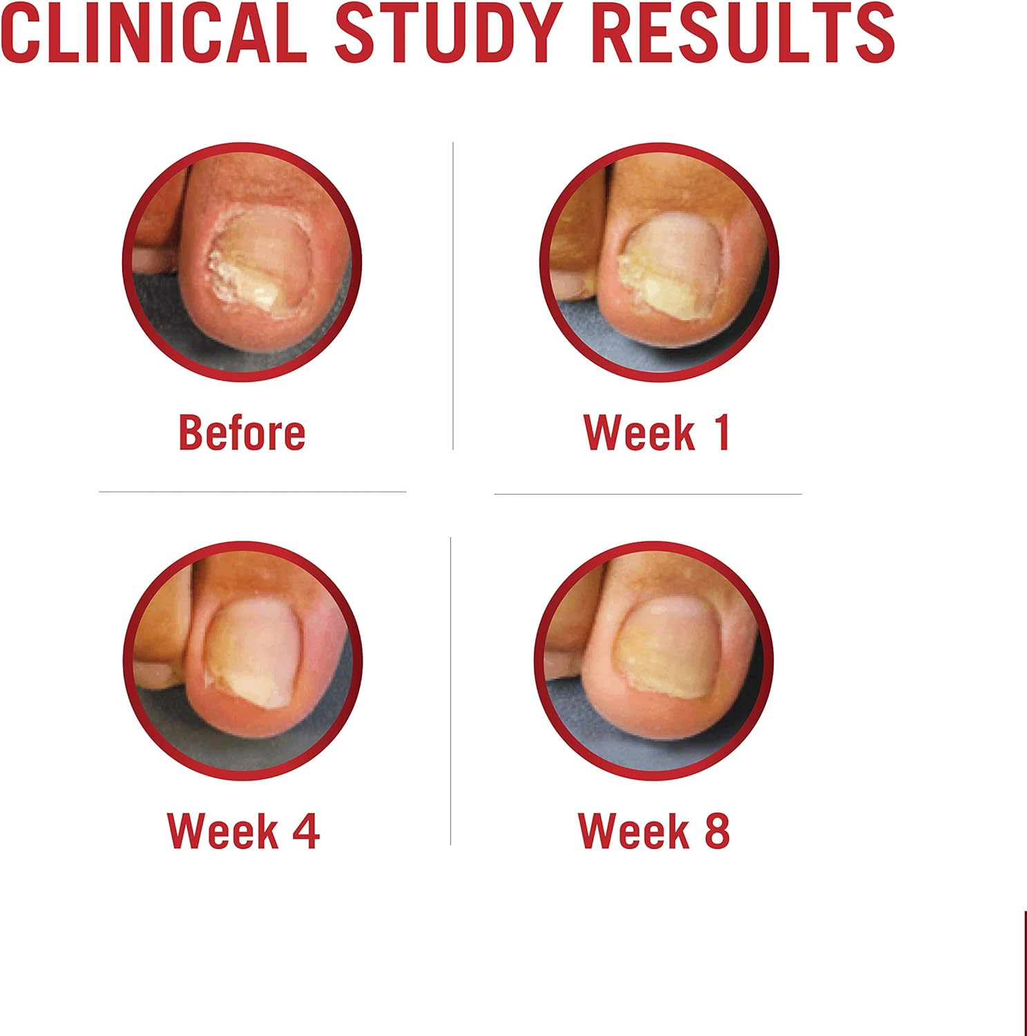 Kerasal Fungal Nail Renewal Treatment 10ml, Restores The Healthy Appearance of Nails Discolored or Damaged by Nail Fungus. (Packaging May Vary): Health & Personal Care