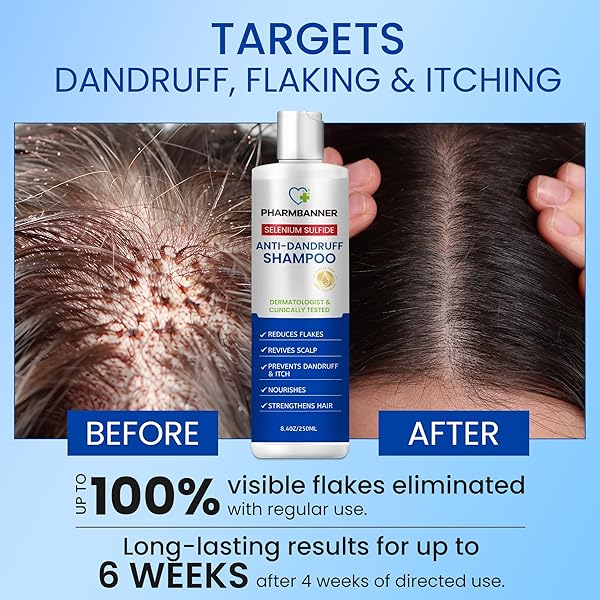 PHARMBANNER ANTI-DANDRUFF SHAMPOO WITH SELENIUM SULFIDE: FOR FLAKY SCALP, ITCHING & SEBORRHEIC DERMATITIS RELIEF – MENTHOL & LAVENDER OIL – MOISTURIZING, COLOR SAFE, GENTLE FOR ALL HAIR TYPES – 8.4OZ