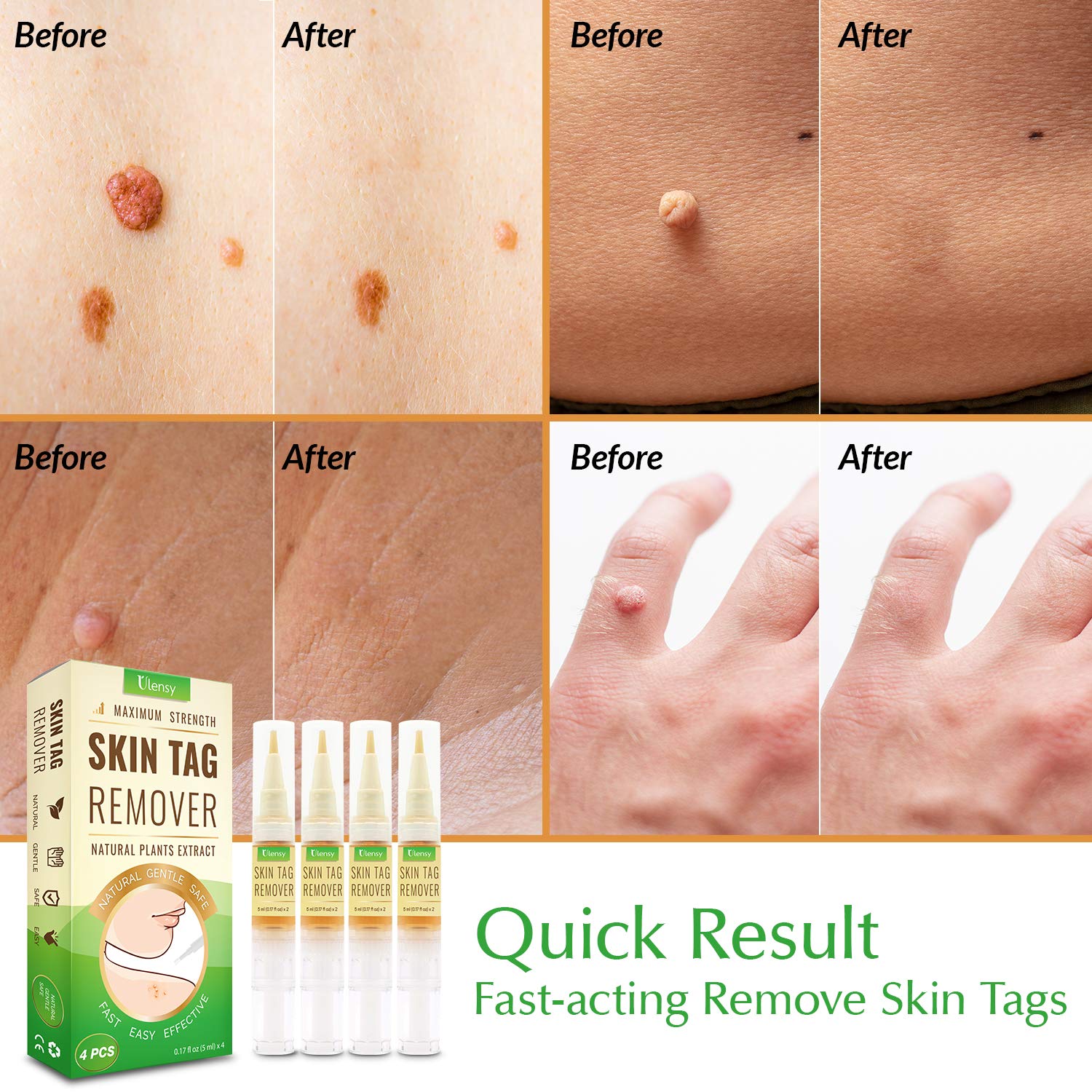 Ulensy 4 PCS Skin Tag Remover with Advanced Formula, Remove Skin Tag Efficiently, Easy and Fast-Acting Skin Tag Remover, 20 ML : Beauty