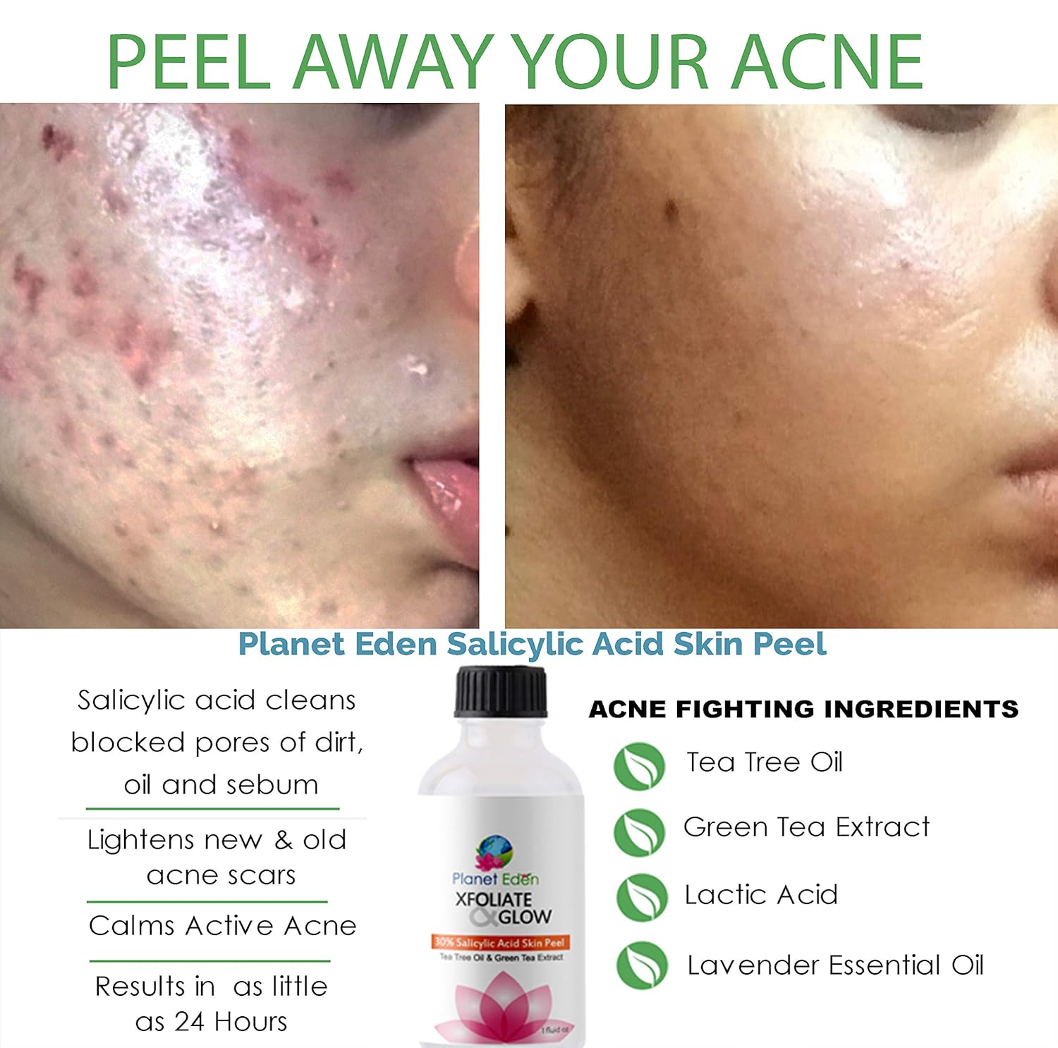 Amazon Com Planet Eden 10 Salicylic Acid Skin Acne Peel With Tea
