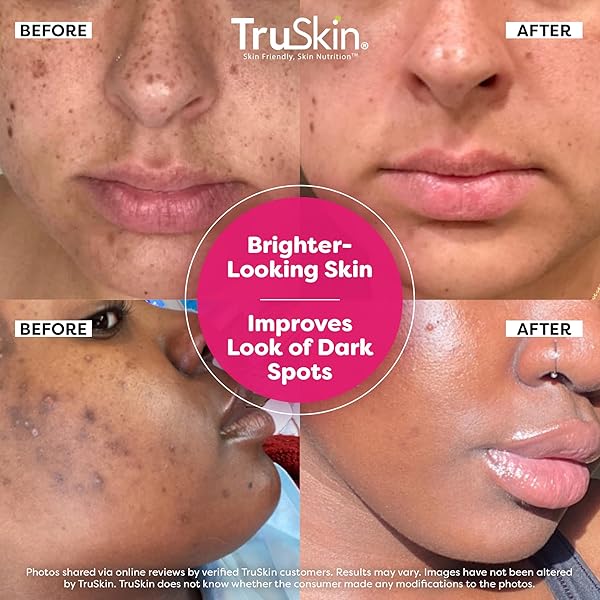 TRUSKIN VITAMIN C SUPER SERUM – NIACINAMIDE, RETINOL, HYALURONIC & SALICYLIC ACID – ALL-IN-ONE ANTI AGING SERUM FOR FACE – IMPROVE APPEARANCE OF DARK SPOTS, FIRMNESS FOR BRIGHTER LOOKING SKIN, 1 FL OZ