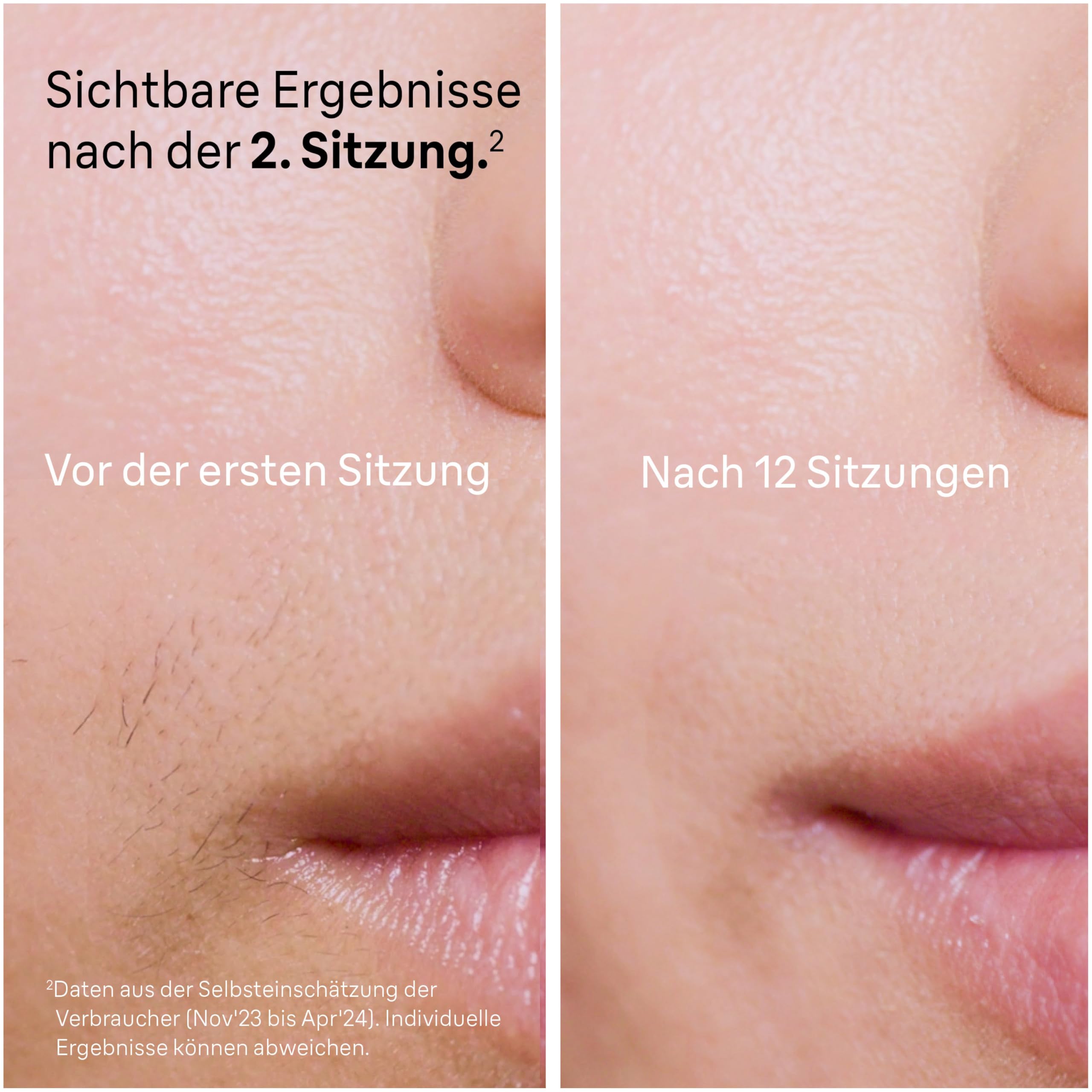 Braun IPL Geräte Haarentfernung Silk·expert Pro 5 — Dauerhaft und Schmerzfrei Haarentfernung für Zuhause — Inkl. Etui, Gillette Venus Rasierer, 3 Aufsätze, Designed in Germany — PL5262, Weiß/Gold 4