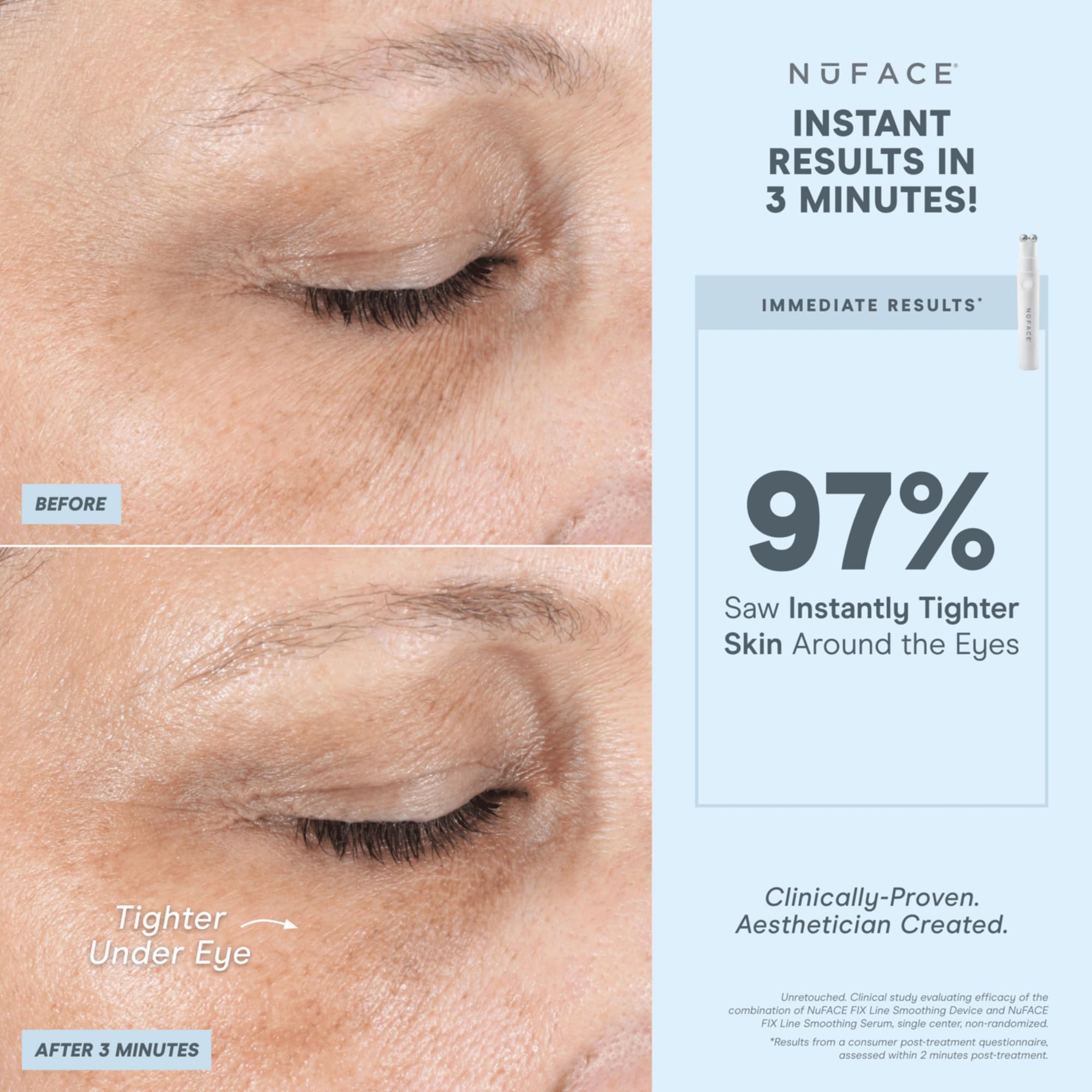 NuFACE FIX Line Smoothing Starter Kit - FDA Cleared Microcurrent Device + Serum Activator for On-The-Go Treatment of Forehead Lines, Crow's Feet, Under Eyes, Smile & Fuller-Looking Lips