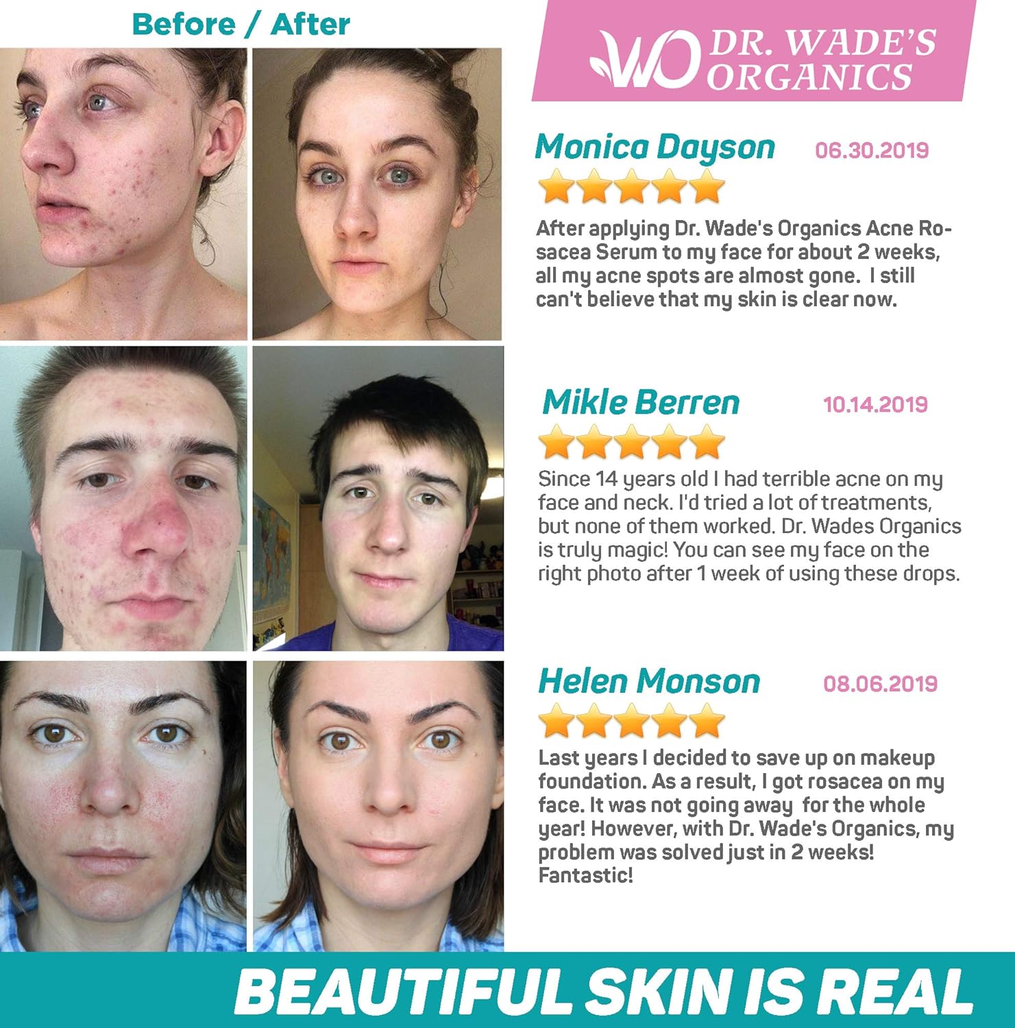 Acne Treatment Serum - Natural Skin Care Serum for Acne and Dark Spots with Niacinamide, Tea Tree Oil, Hyaluronic Acid & Tamanu Oil - Effective Rosacea Treatment - Acne Serum for Oily Skin: Beauty