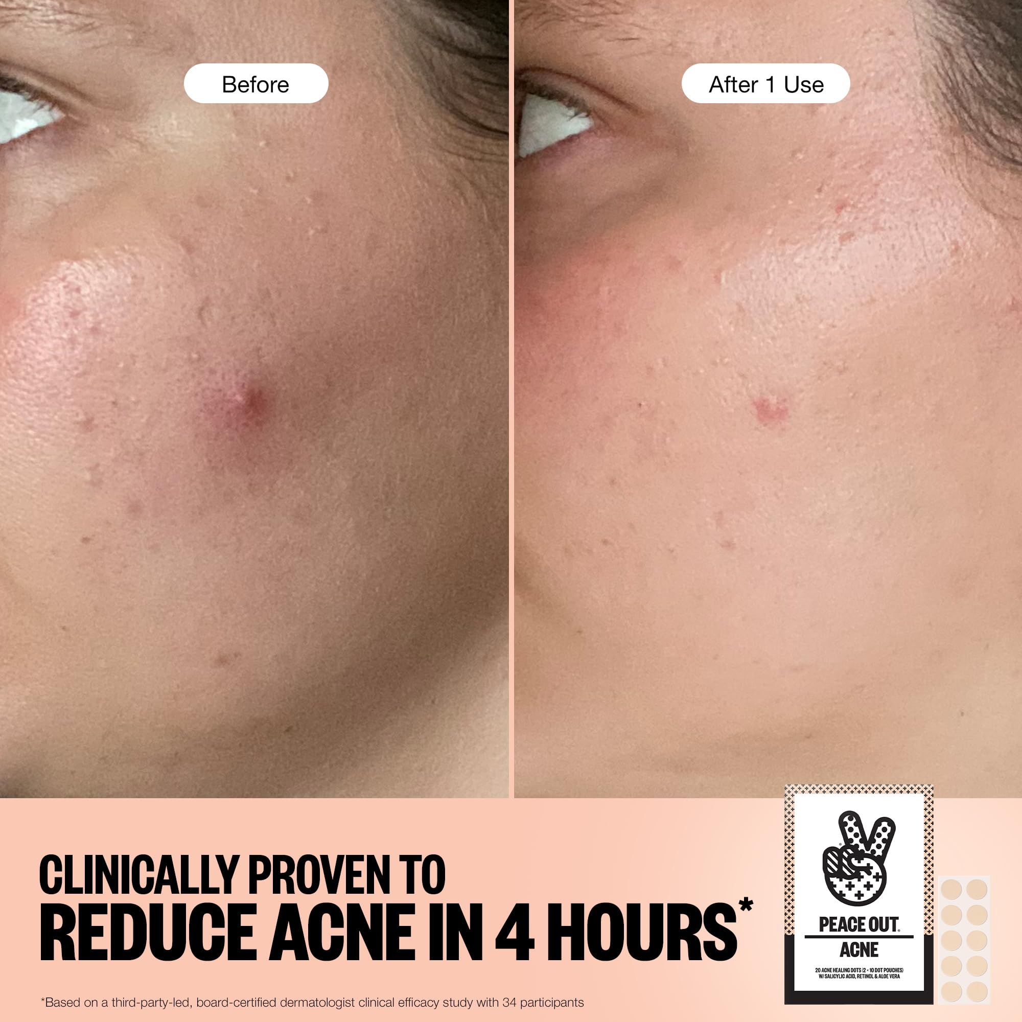 PEACE OUT Skincare Acne Dots, Hydrocolloid Pimple Patches Help Clear Blemishes Overnight, Award Winning Fast Acting Anti-Acne Solution (20 dots)