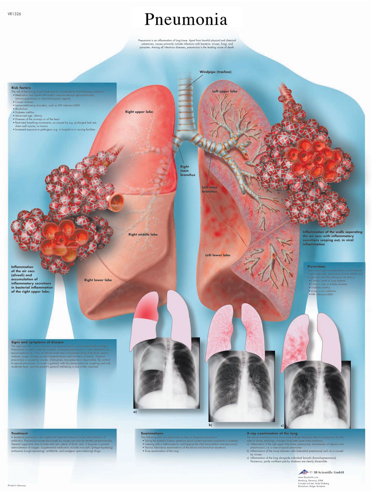 3B Scientific Human Anatomy - Pneumonia Chart, Laminated Version