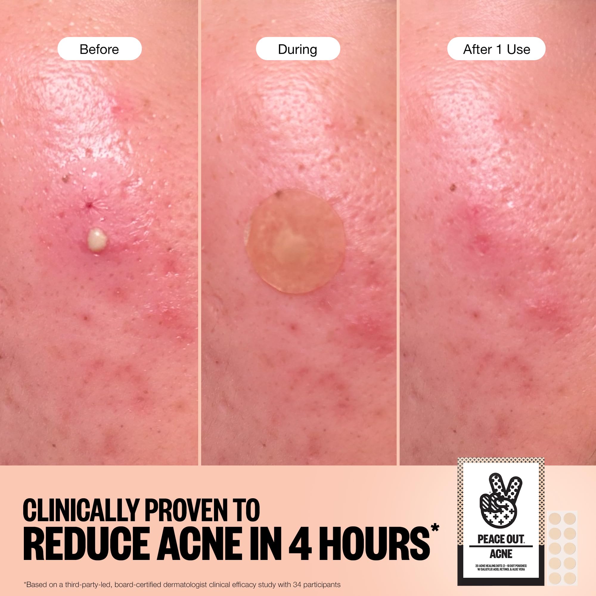PEACE OUT Skincare Acne Dots, Hydrocolloid Pimple Patches Help Clear Blemishes Overnight, Award Winning Fast Acting Anti-Acne Solution (20 dots)