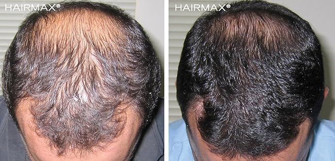 防脱生发 HairMax LaserBand 41 红光防脱 光束健发带生发仪 优惠券折后7.75 海淘转运到手¥3805 中亚Prime会员免运费直邮到手约¥4266 天猫¥4940