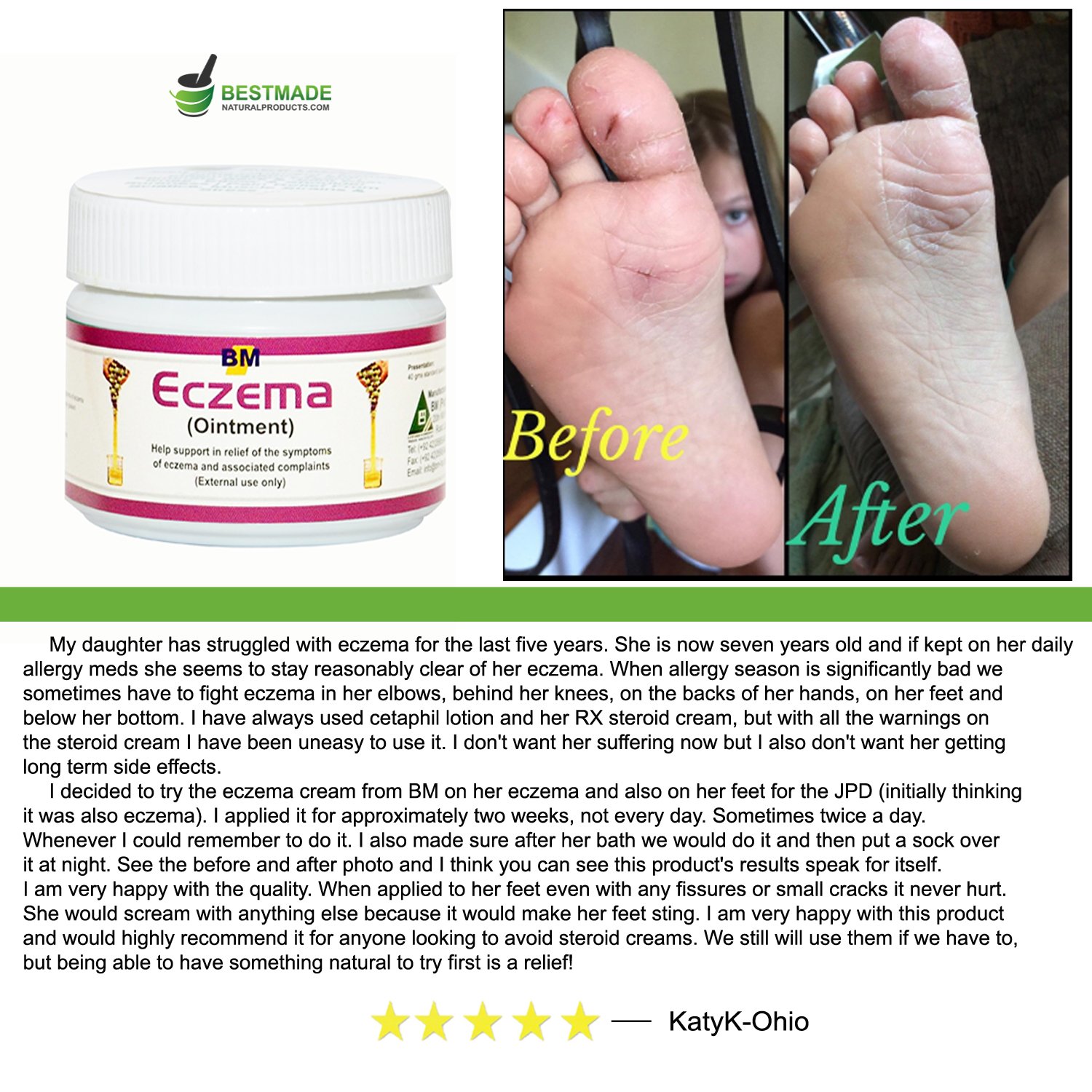 Eczema Ointment, 40gm, a Natural Treatment for Eczema, Psoriasis and Dermatitis, Instant Relief