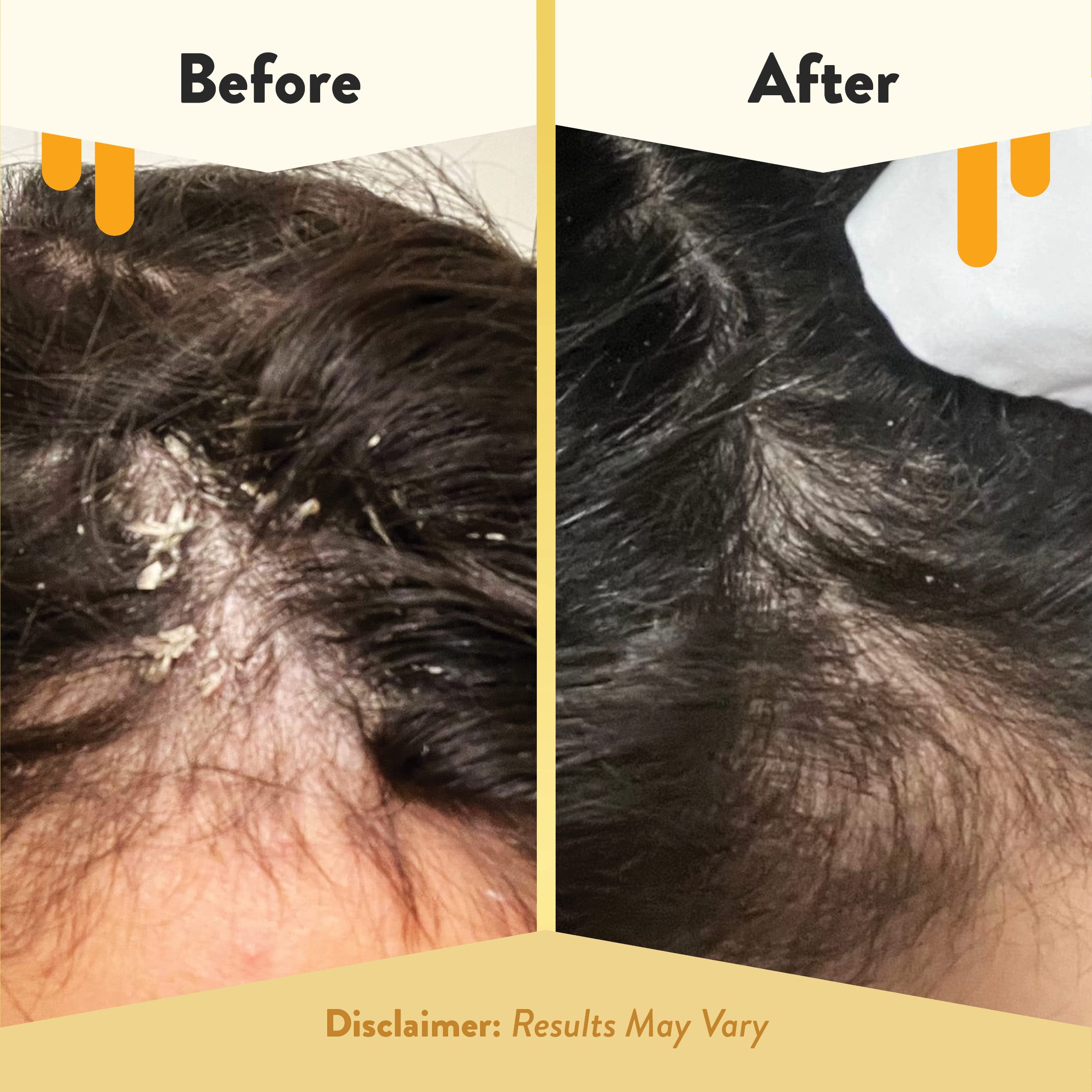 ECZEMA HONEY Soothing Scalp Oil - Natural Honey Hair Oil & Scalp Care - Daily Itchy Scalp Relief Serum - Dry Scalp Treatment Helps With Psoriasis, Seborrheic Dermatitis, Dandruff & More (1 Oz)