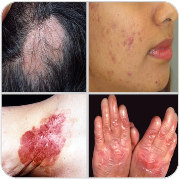 skin diseases treatment