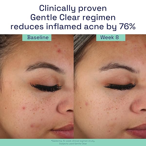CETAPHIL ACNE FACE WASH, GENTLE CLEAR CLARIFYING ACNE CREAM CLEANSER WITH 2% SALICYLIC ACID, DEEP CLEANS & TREATS ACNE PRONE SKIN, SKIN CARE FOR SENSITIVE SKIN, 4.2OZ