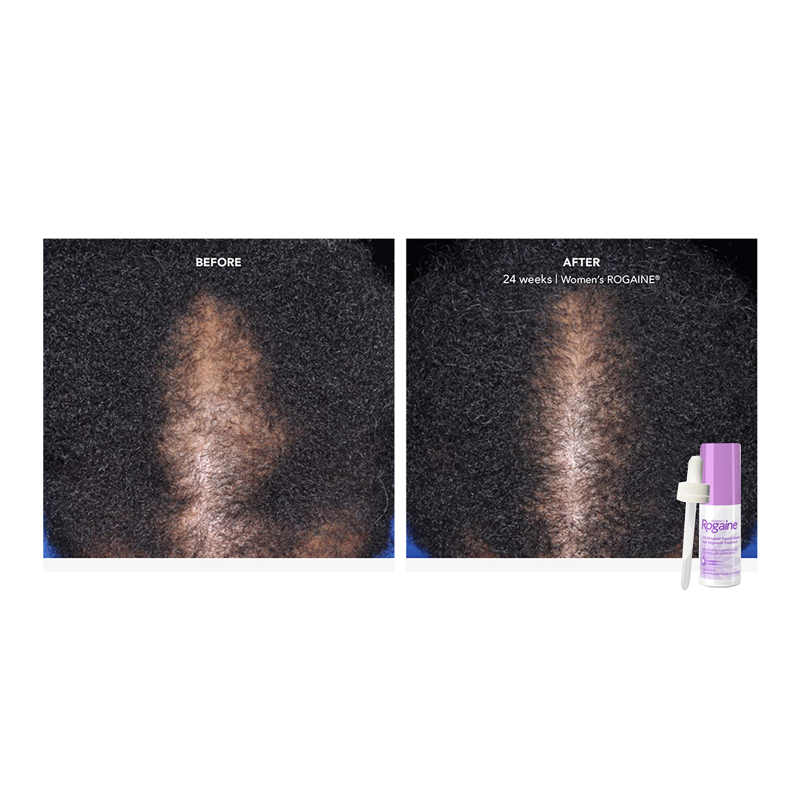 Women's Rogaine 2 Minoxidil Topical Solution for Hair Thinning and