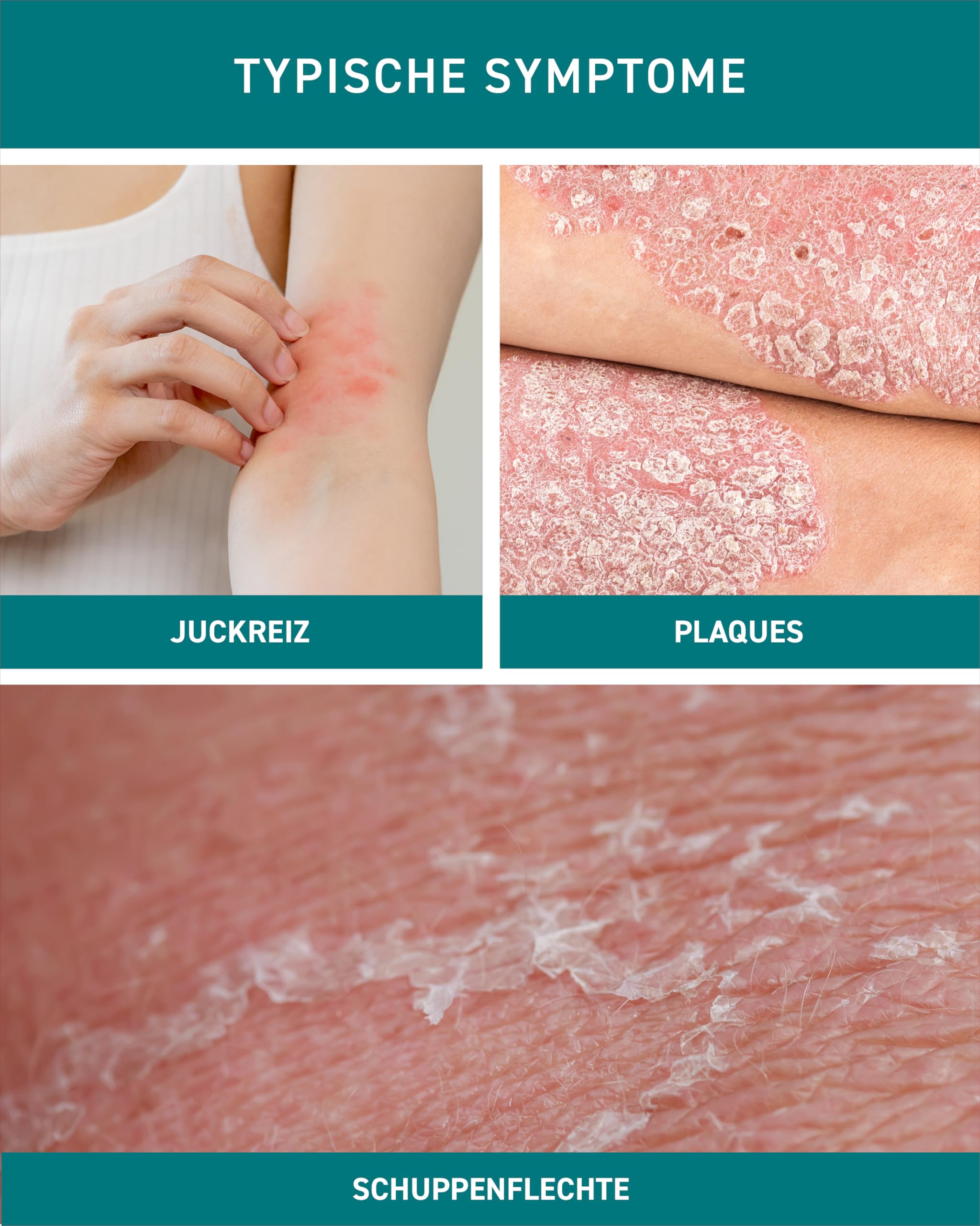 N1 Psoriasis Intensivcreme 50 ml - Schnelle Hilfe gegen starken Juckreiz - Effektiv gegen Schuppenflechte, Neurodermitis & Ekzeme - Beruhigt und lindert rote, schuppige, entzündete & trockene Haut 4
