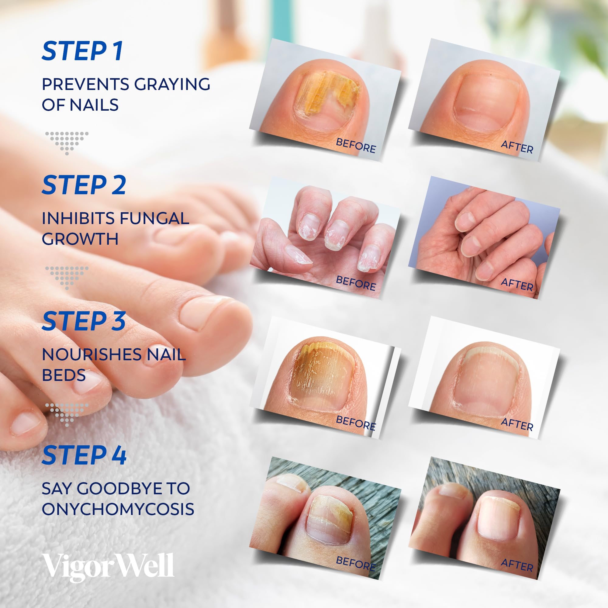 Toenail Fungus Treatment Extra Strength - (Medium) 32 Nighttime Hydrogel Patches for Overnight Toenail Repair - Visible Results in 8 Hours - Fungal Nail Patches for Toenail Fungus Relief - Image 4