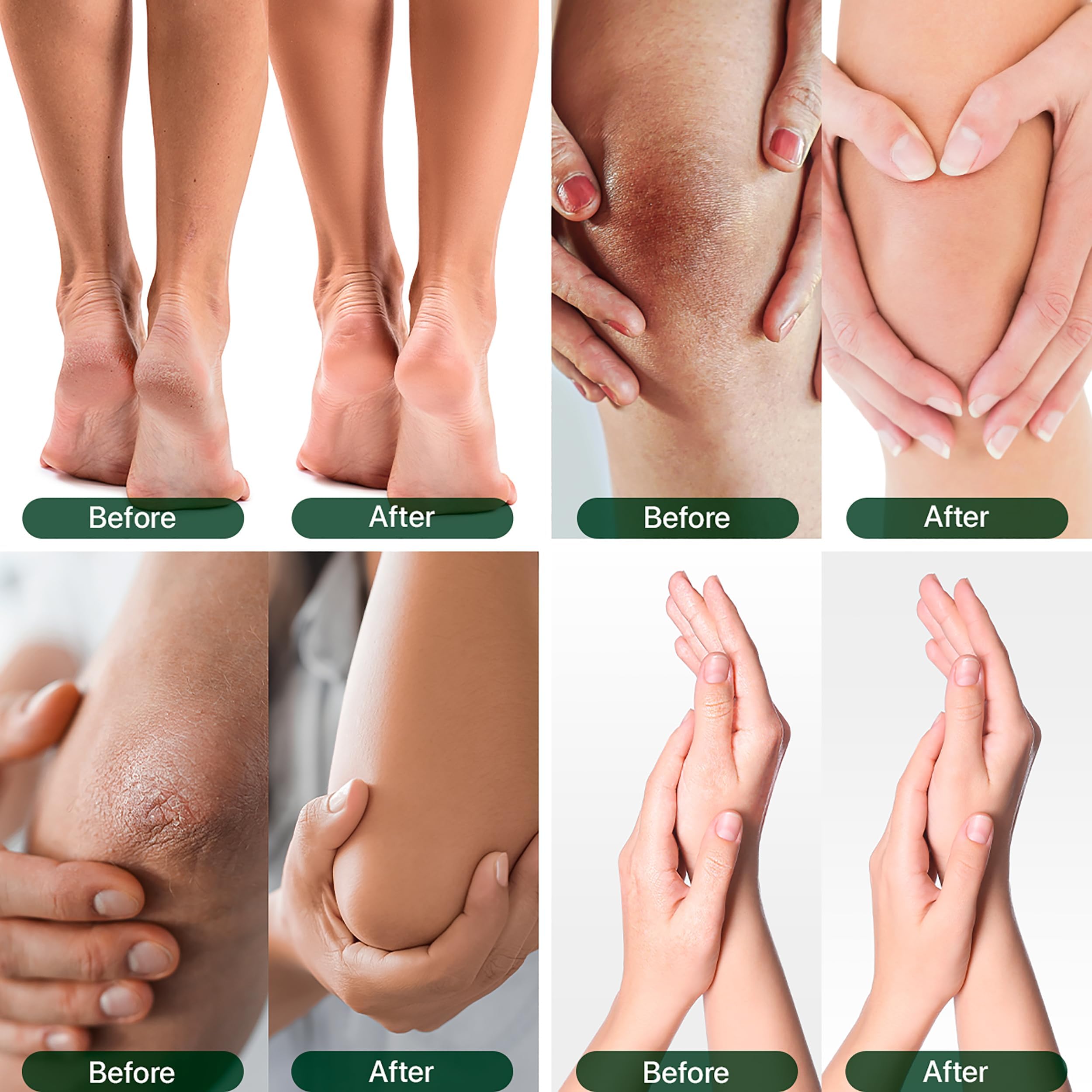 REMEDIAL PAX Urea Cream 40 Percent for Feet, 40% Urea Foot Cream for Dry Cracked Heels Knees Elbows Callus Hands with 2% Salicylic Acid, Foot Moisturizer, Moisturizer for Feet Care
