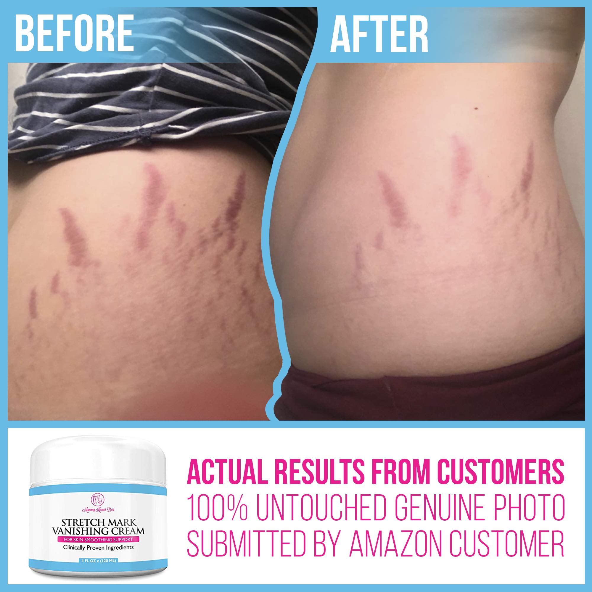 Stretch Mark Cream For Pregnancy And Scar Removal 100 Retinol Free Mommy Knows Best Maternity 