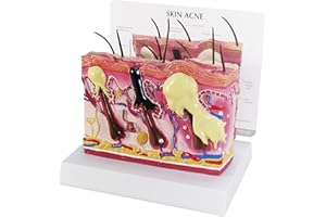 GPI Anatomicals - Skin Acne Model, Cross-Section Showing Normal and Common Acne-Riddled Skin for Human Anatomy, Physiology Education, Anatomy Model for Doctor's Office, Medical Learning Resources