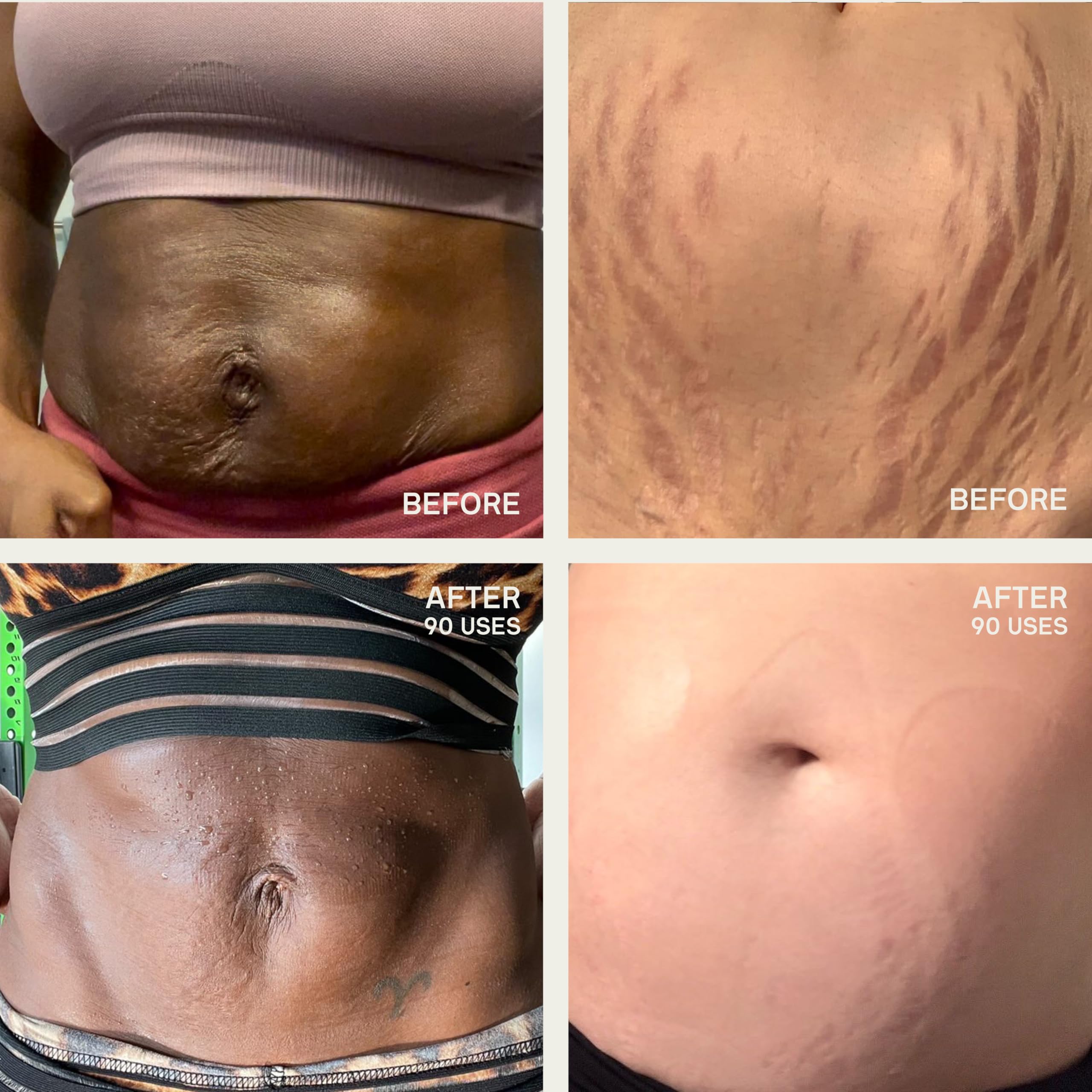 Dermaclara Large Body Patch - Pregnancy Stretch Mark Prevention & Removal, C Section Cover Up Belly Scar Sheet, Maternity Skincare, Mom to Be Silicone Gel Sheet, Reusable up to 30 Times - 1 Patch