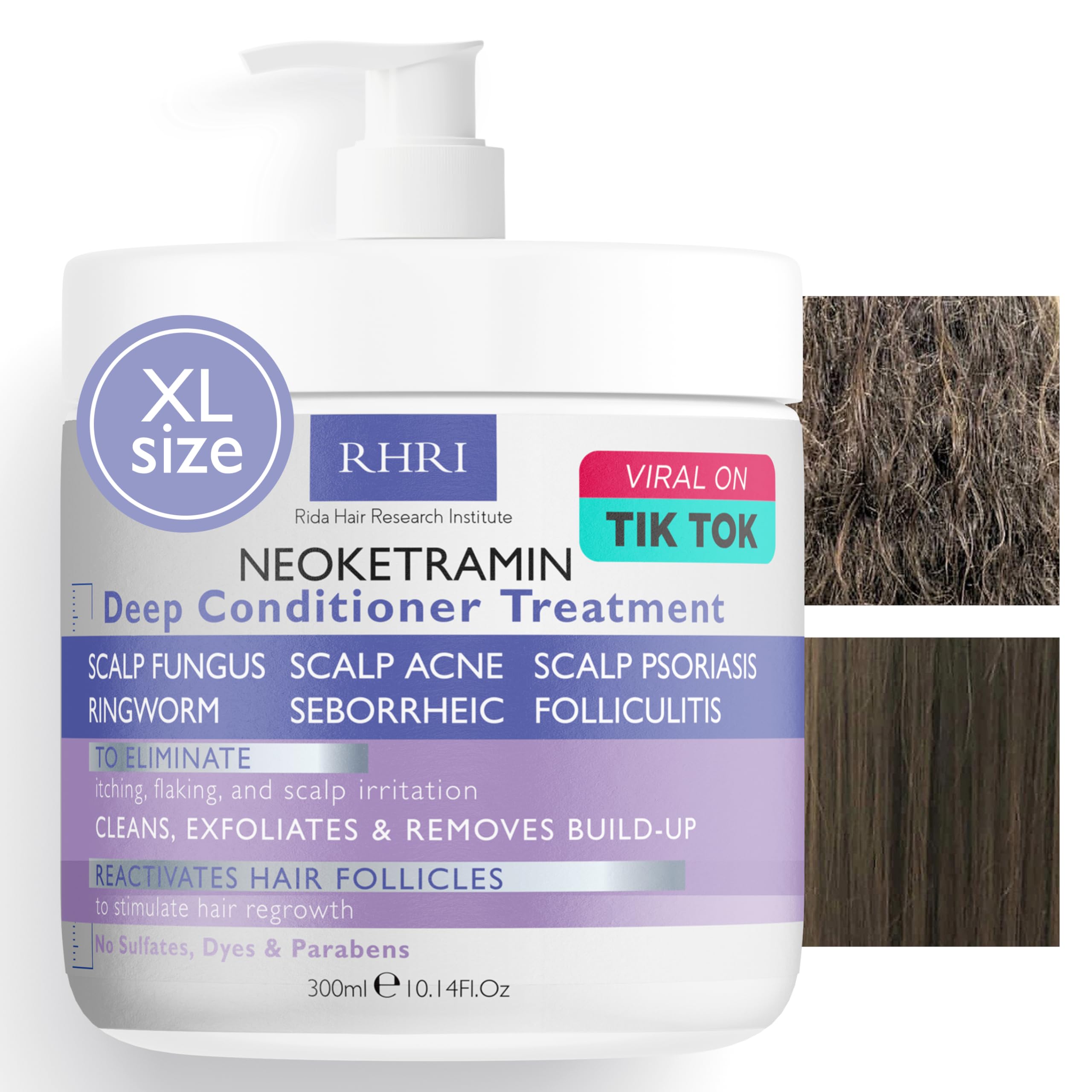 Photo 1 of Anti Fungal Deep Conditioner for Men and Women | Scalp Treatment for Psoriasis, Dandruff, Seborrheic Dermatitis | Provides Relief from Folliculitis, Eczema, Itchy, Flaky and Dry Scalp