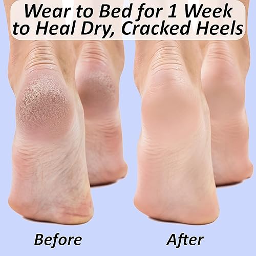 Heel Fissures Bottom Of My Feet Are Dry And Cracking Cracks In