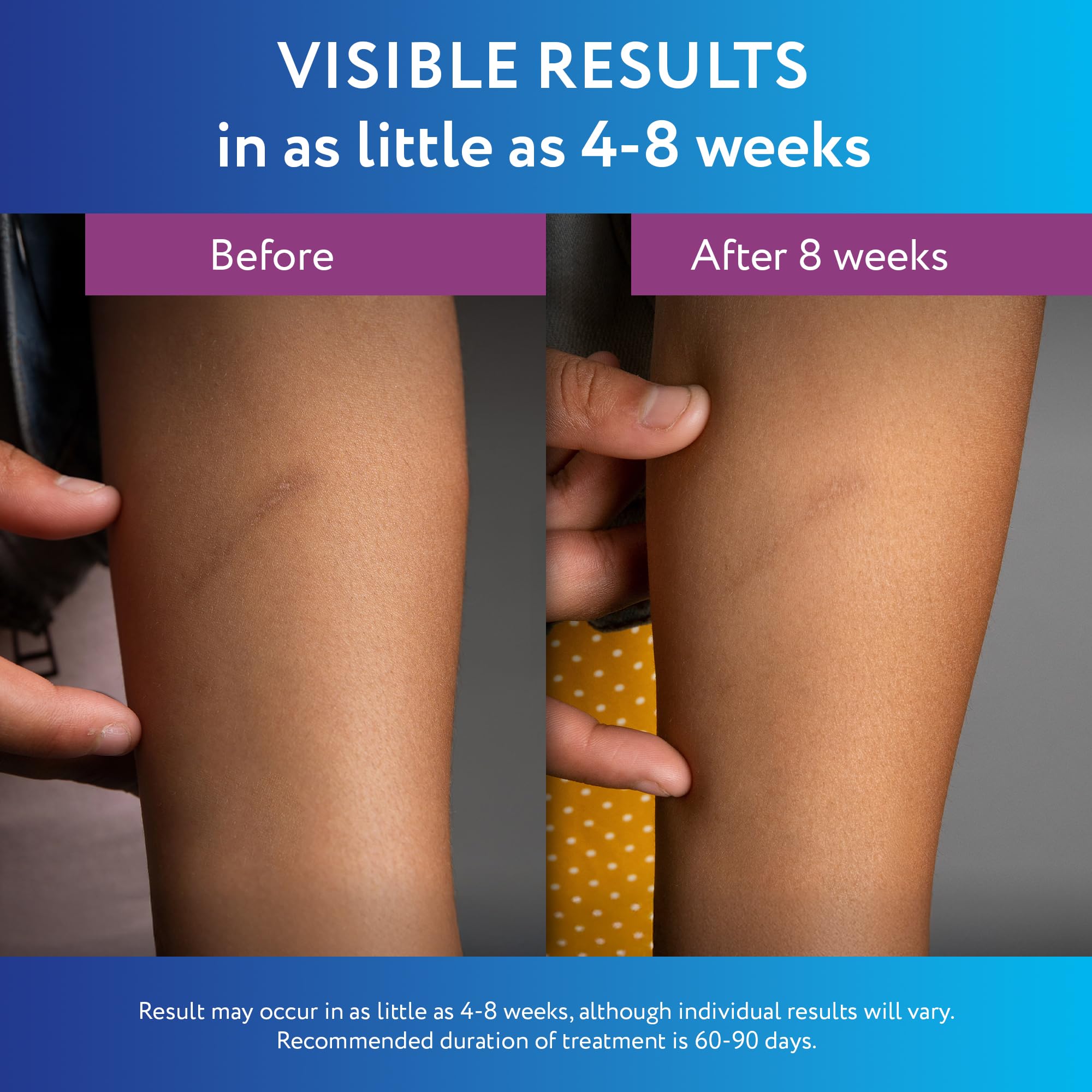 ScarAway Silicone Scar Gel, Helps Improve Size, Color & Texture of Hypertrophic & Keloid Scars from Injury, Burns & Surgery, Water Resistant, 10g (0.35 Oz)