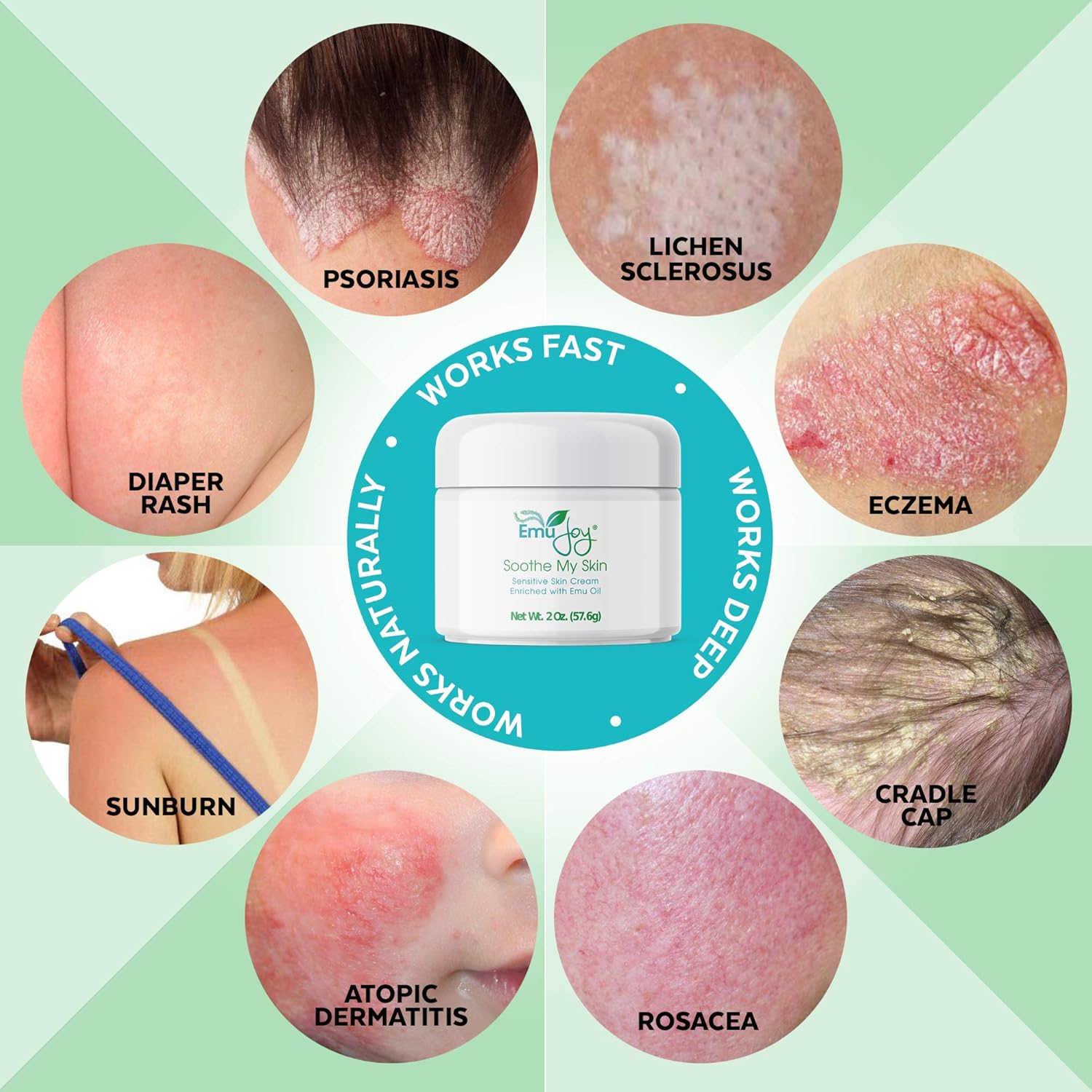 Amazon Com Soothe My Skin Cream For Sensitive Skin Eczema Cream Psoriasis Atopic Dermatitis Lichen Sclerosus Emu Oil Cream With Only Natural Ingredients Beauty