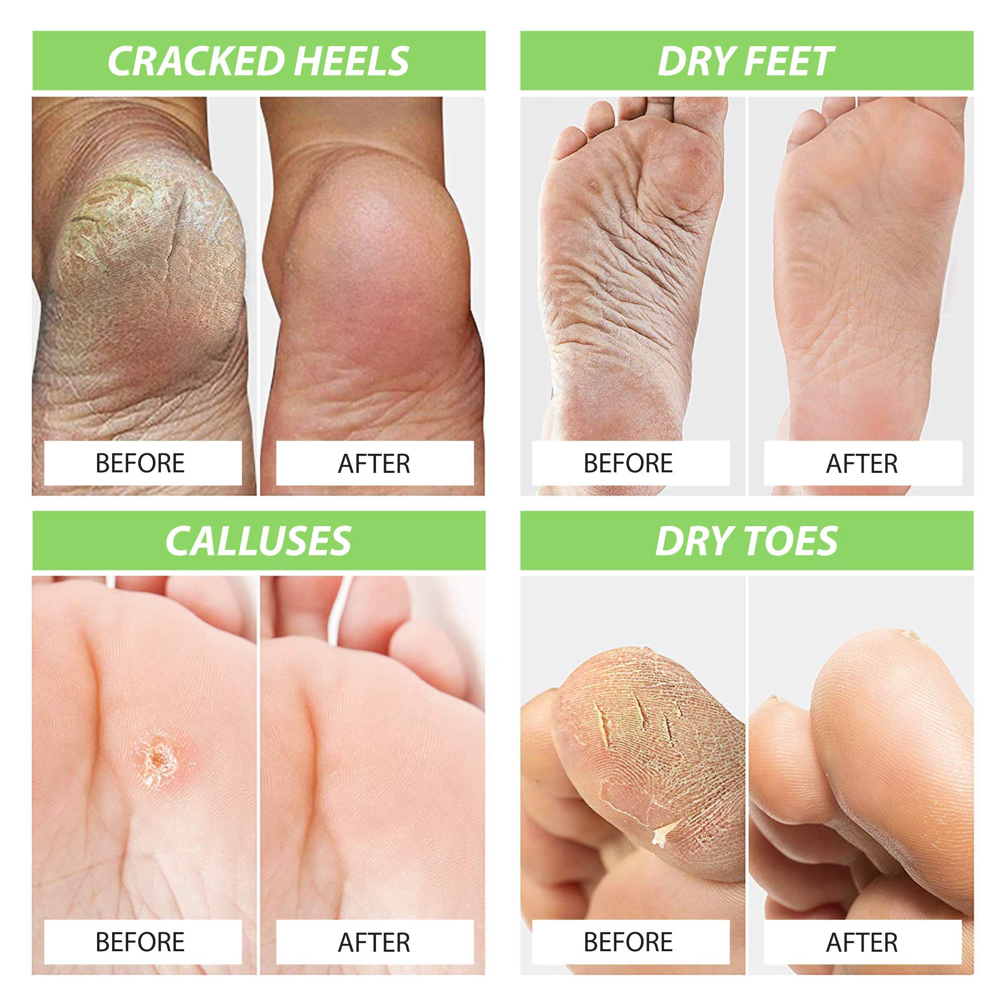 Mua Foot Cure Tea Tree Oil Foot SOAK with EPSOM Salt Extra Strength Formula for Toenail