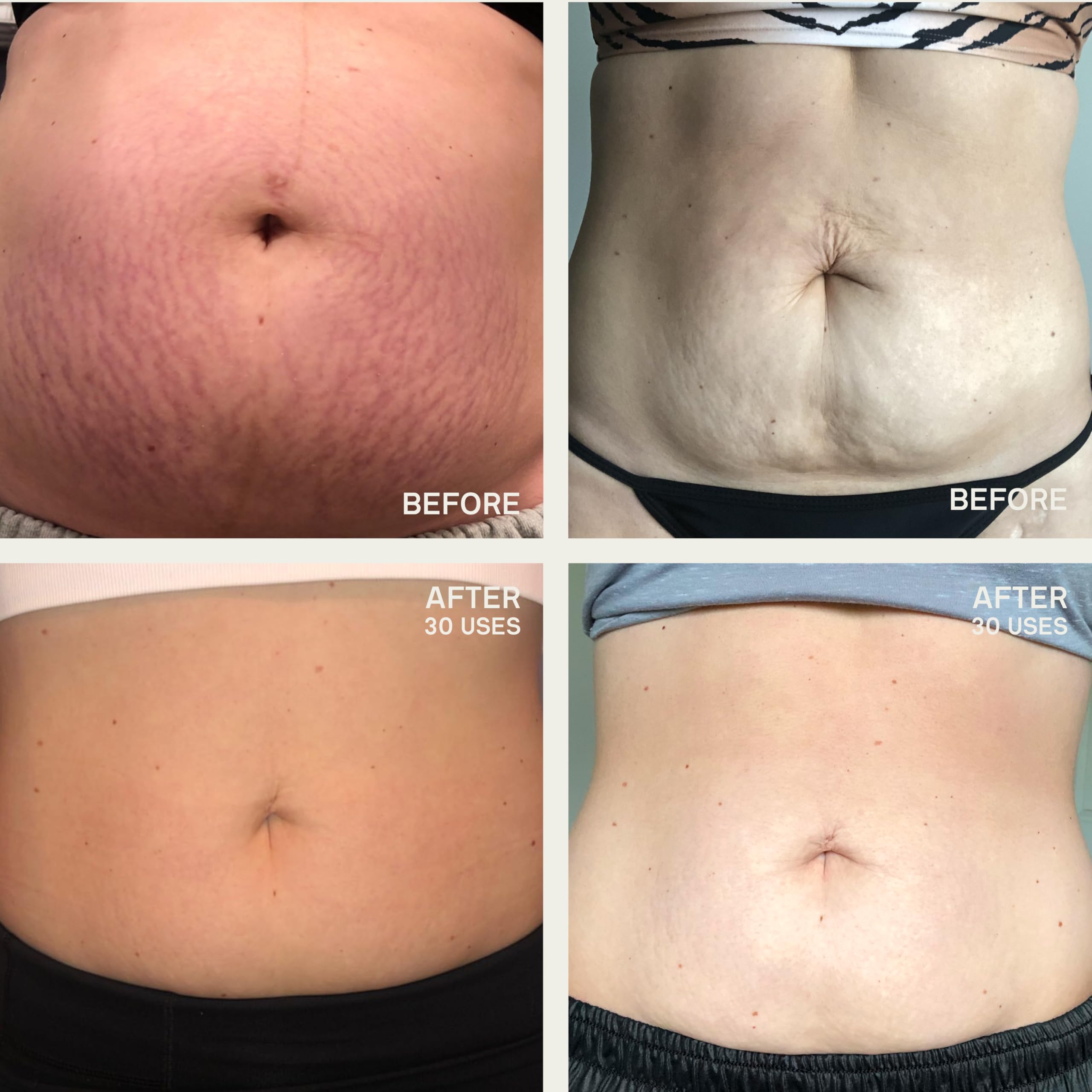 Dermaclara Large Body Patch - Pregnancy Stretch Mark Prevention & Removal, C Section Cover Up Belly Scar Sheet, Maternity Skincare, Mom to Be Silicone Gel Sheet, Reusable up to 30 Times - 1 Patch