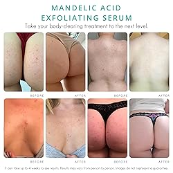 Body Clearing Serum [1 Fl Oz] Level 2 Acne Serum