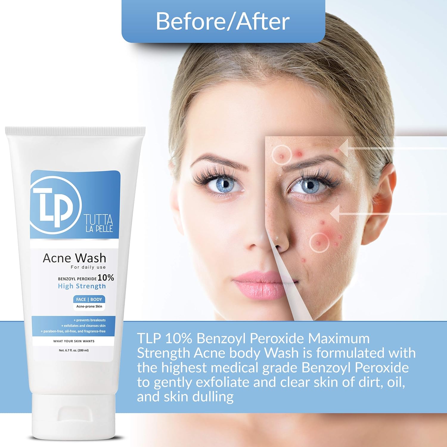 highest benzoyl peroxide