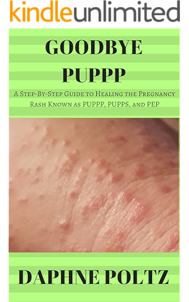 Goodbye Puppp A Step By Step Guide To Healing The Pregnancy Rash Known As Puppp Pupps And Pep Kindle Edition By Poltz Daphne Health Fitness Dieting Kindle Ebooks Amazon Com