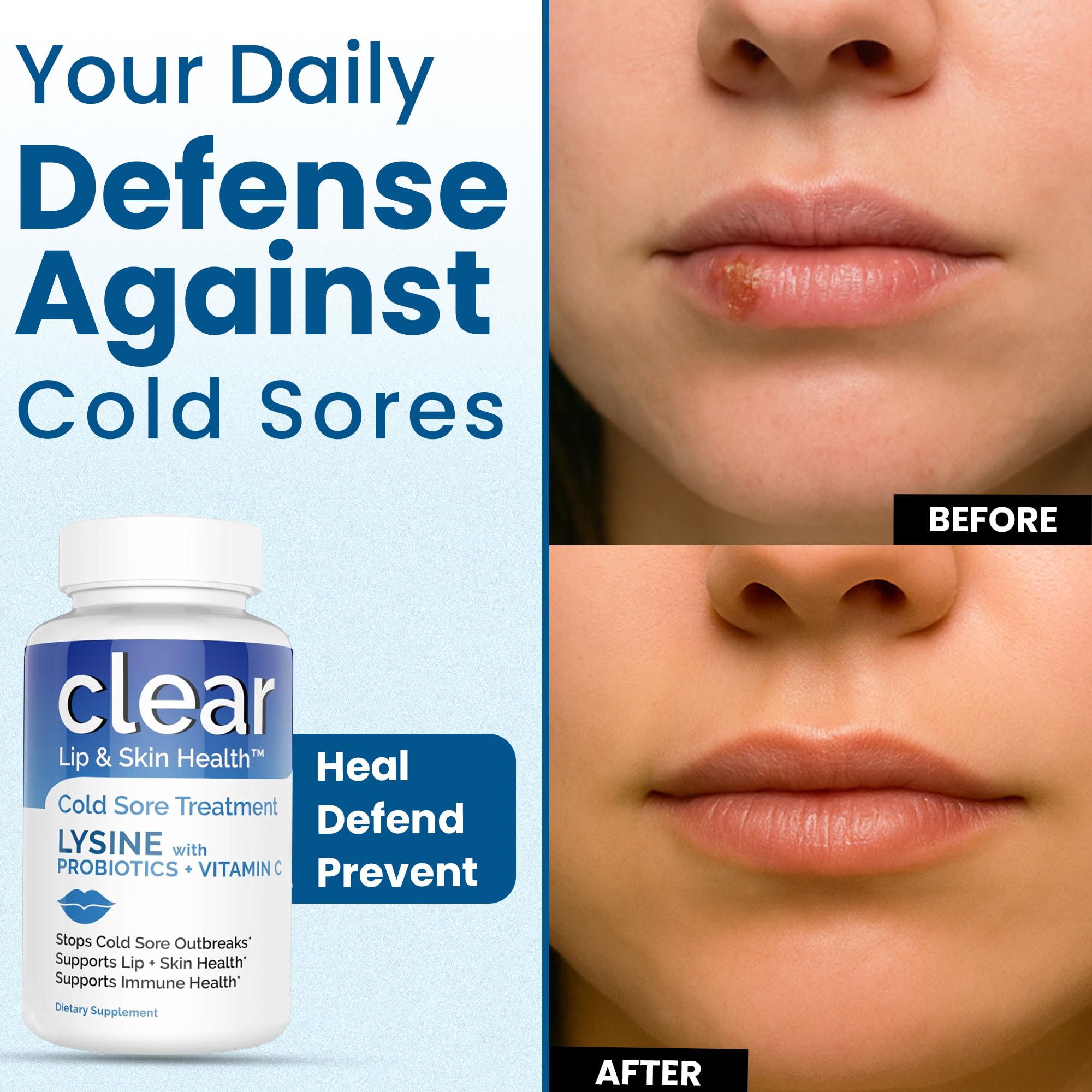 Lysine Cold Sore Treatment for Lips with Pre-Probiotics & VIT C | 1 Month Supply | Supercharged Lysine Capsules with Rhamnosus & Acidophilus for Cold Sores Relief, Skin + Gut Health & Immune Support