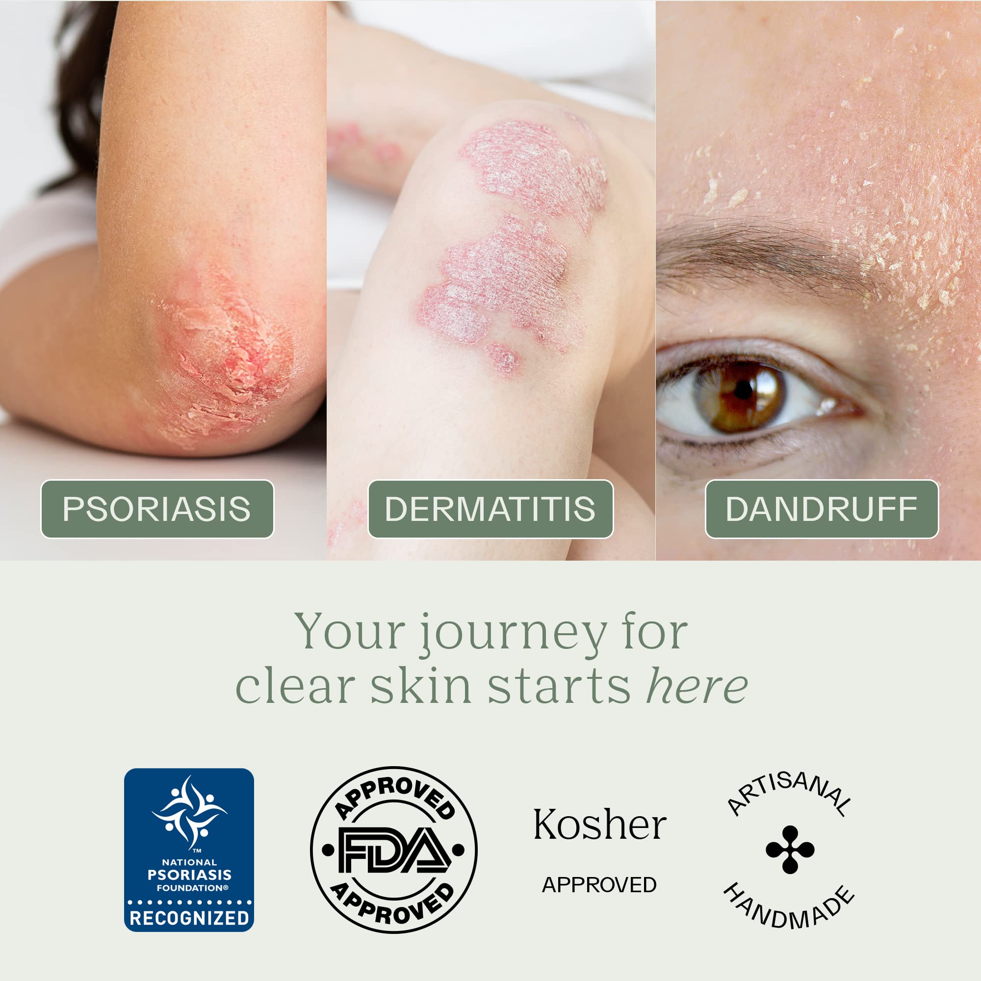 Dermabon Psoriasis Cleanser, Seborrheic Dermatitis & Eczema Soap | Dermatologist Recommended | 2% Coal Tar - Soothes Itching, Reduces Inflammation, Moisturizes Skin, Daily Use - 6 Pack