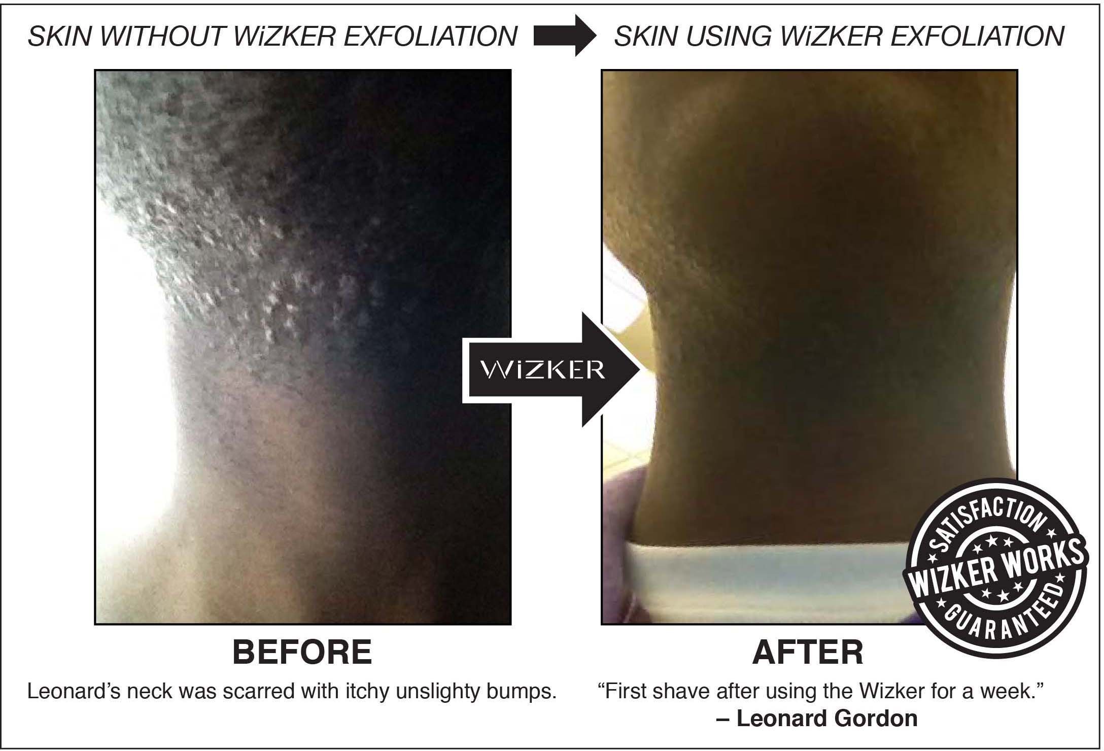 Waterproof Exfoliating Brush Stops Ingrown Hair Razor Bumps