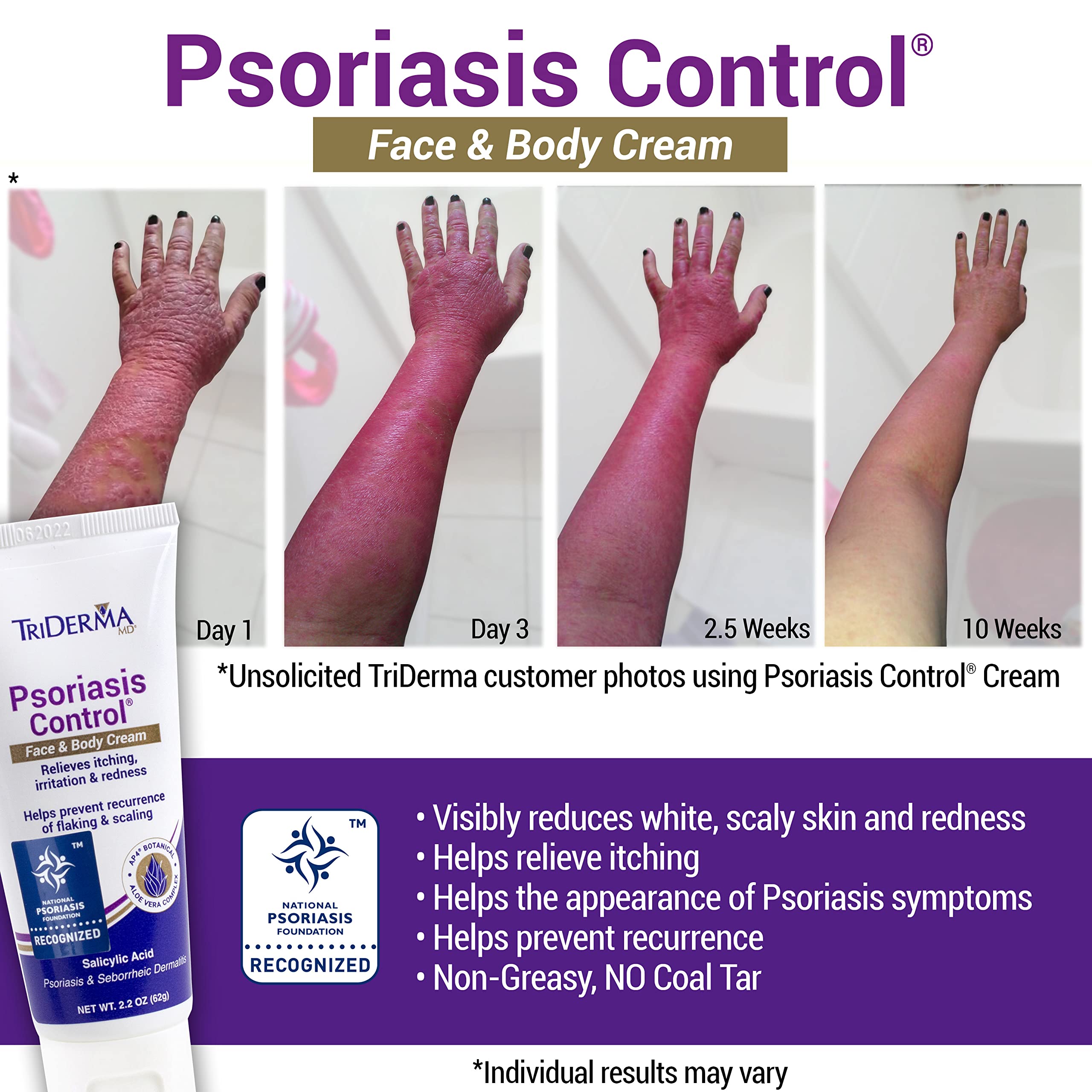 TriDerma Psoriasis Control Face & Body Cream - Maximum Strength 3% Salicylic Acid - Moisturizing Psoriasis Cream (No Cortisone, Fragrance or Parabens) - 2.2 oz