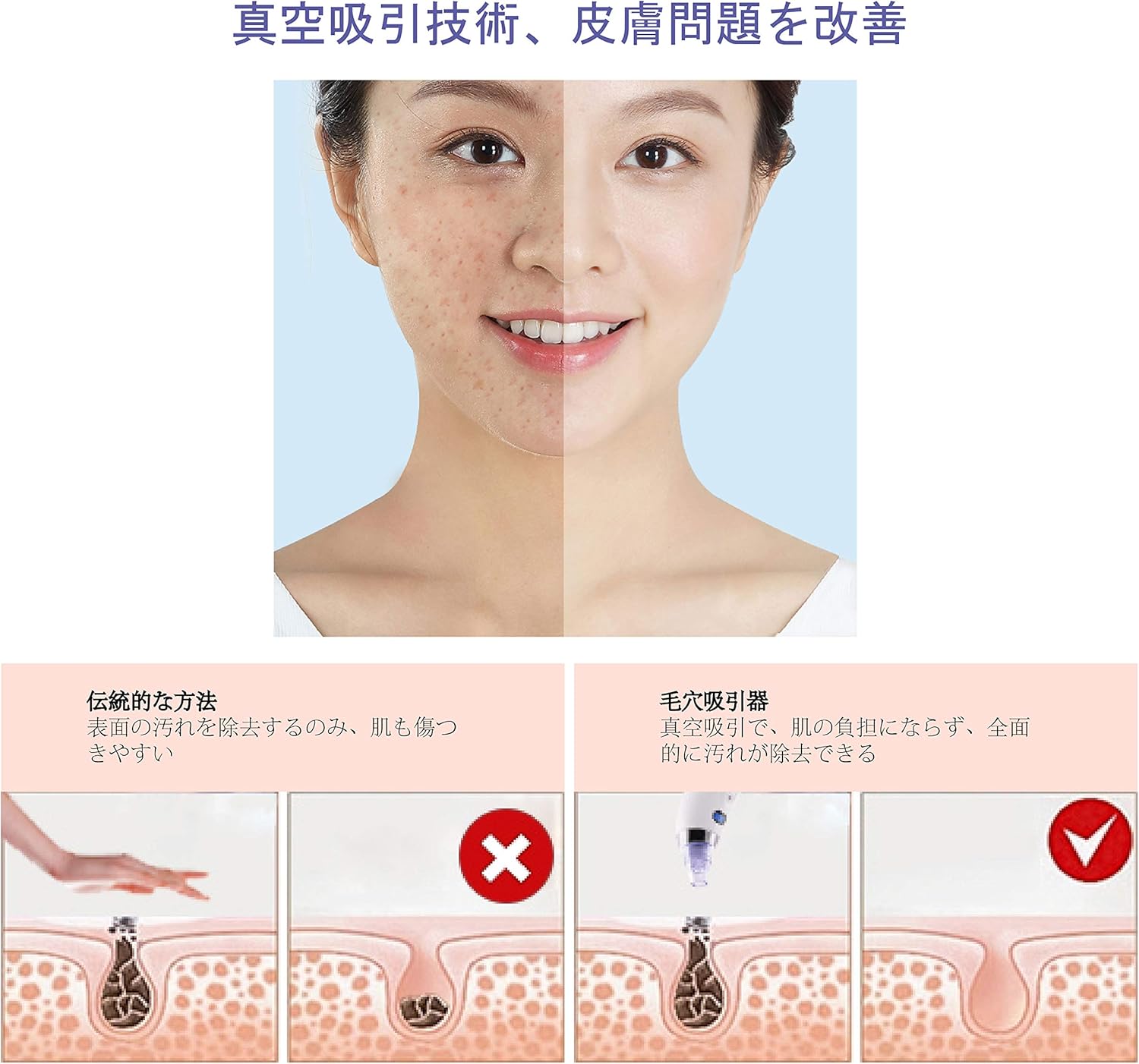 Amazon Moulei 毛穴吸引器 ニキビ吸引 黒ずみ吸出し 角栓とり たるみ改善 しわ減少 美顔器 鼻 5段階吸引力 4ヘッド付属 Usb充電式 ワイヤレス 持ちやすい 毛穴クリーン 皮膚改善 フェイス 体 ケア 男女兼用 日本語説明書 付き Moulei 美顔器 美容器 通販