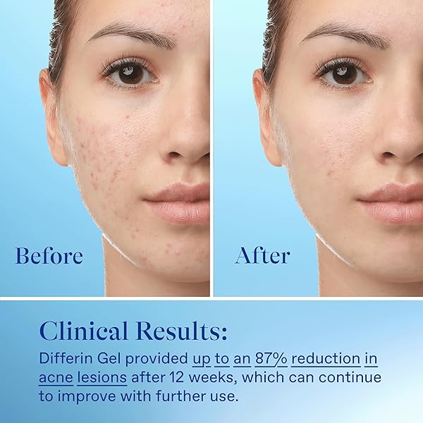 DIFFERIN ACNE TREATMENT GEL, 30 DAY SUPPLY, RETINOID TREATMENT FOR FACE WITH 0.1% ADAPALENE, GENTLE SKIN CARE FOR ACNE PRONE SENSITIVE SKIN, 15G TUBE (PACKAGING MAY VARY)