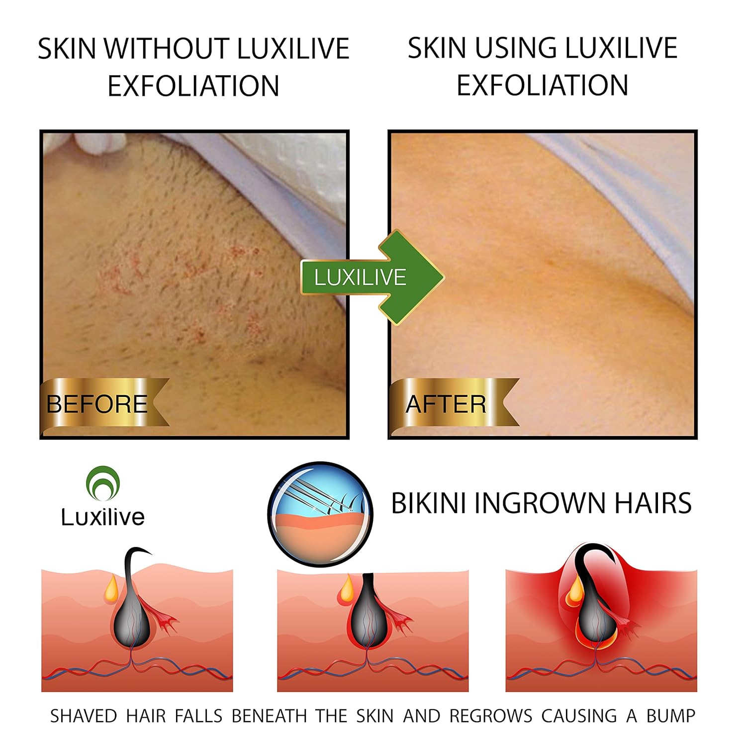Luxilive Exfoliator Brush Ingrown Hair Stainless Steel Tweezer