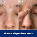 Patch Perfect Spot Patches 102 Count Korean Hydrocolloid Pimple Patches view 6