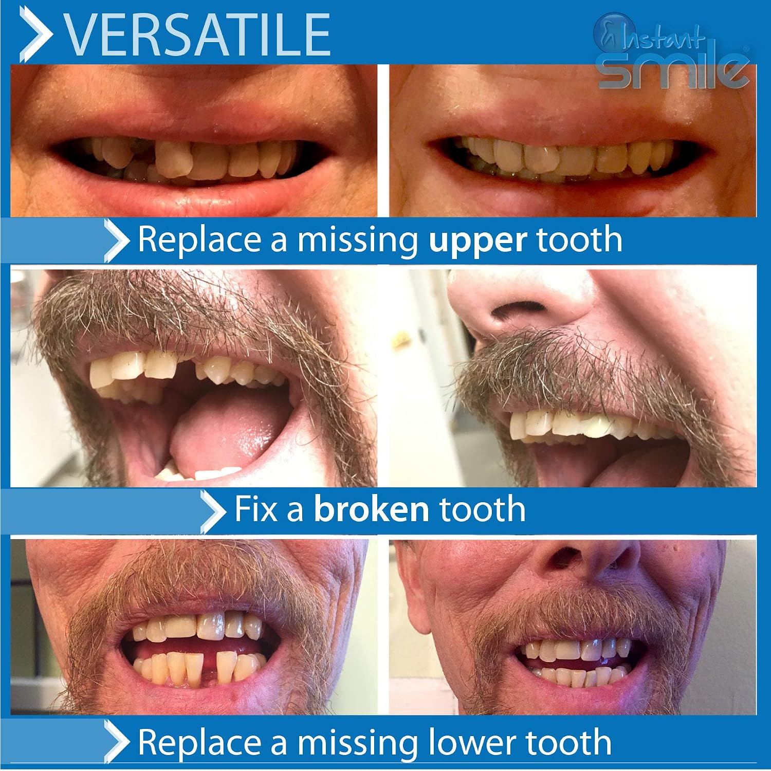 Instant Smile Pro Series Temporary Tooth Replacement Kit, 40 Different False Teeth, Variety of Shapes and Colours - Image 5