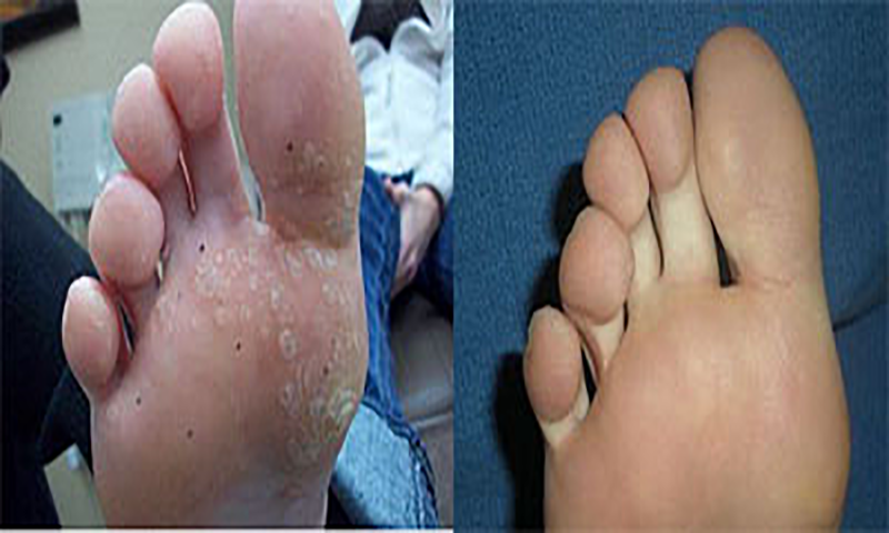 Skin Tag Removal : Discover How You Can Completely Eliminate Moles, Warts, Skin Tags Naturally