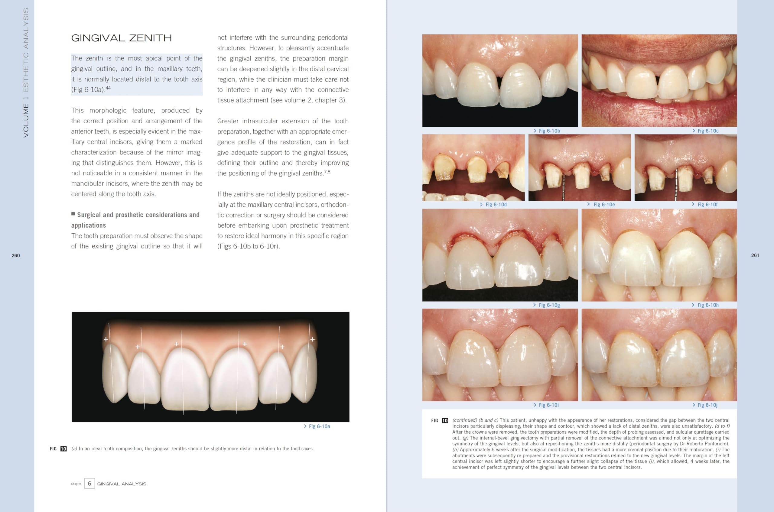 Esthetic Rehabilitation In Fixed Prosthodontics: Esthetic Analysis: A Systematic Approach To Prosthetic Treatment Esthetic Rehabilitation In Fixed Prosthodontics: Esthetic Analysis: A Systematic Approach To Prosthetic Treatment Hardcover